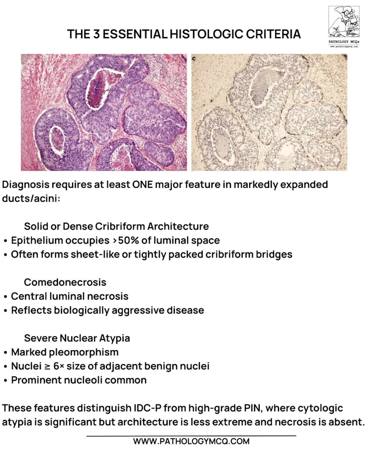 High‑power histology illustrating solid and cribriform intraductal carcinoma of the prostate with comedonecrosis and marked nuclear atypia.