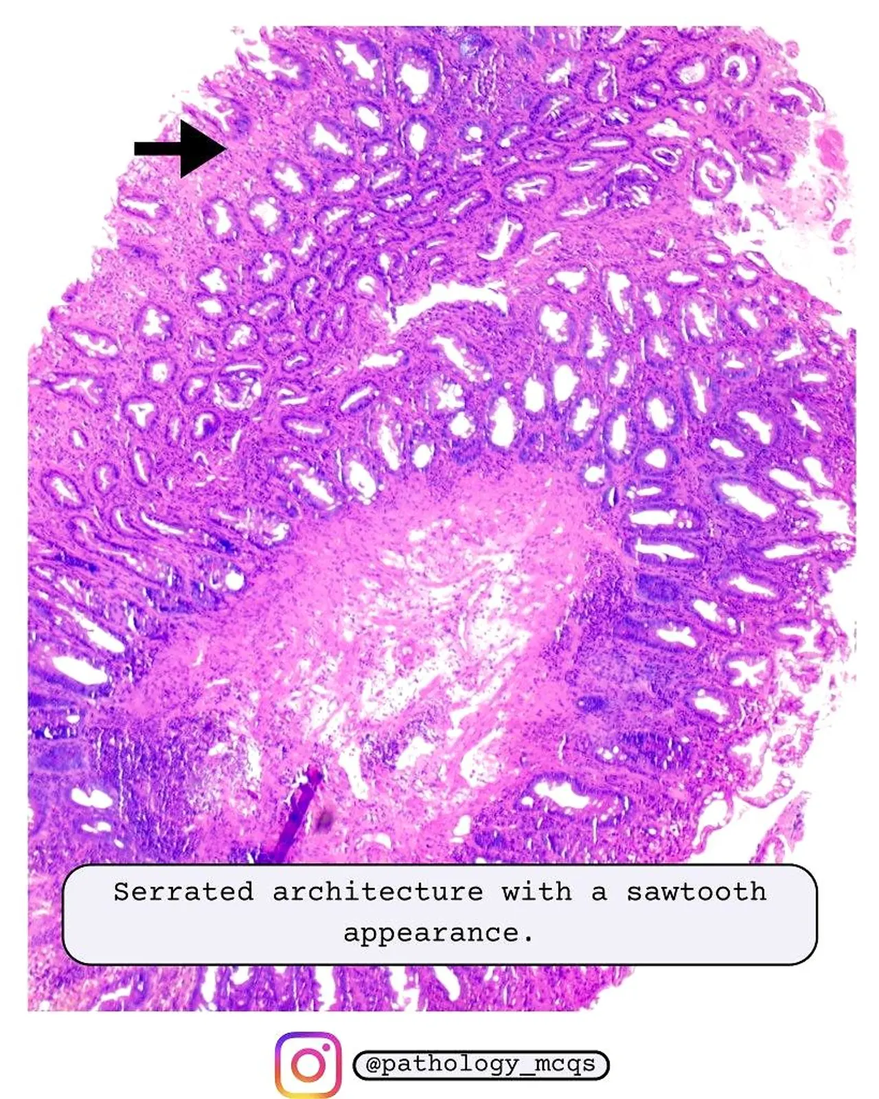 Serrated crypt architecture Microscopic image showing serrated crypt architecture with a sawtooth appearance, characteristic of hyperplastic polyps.