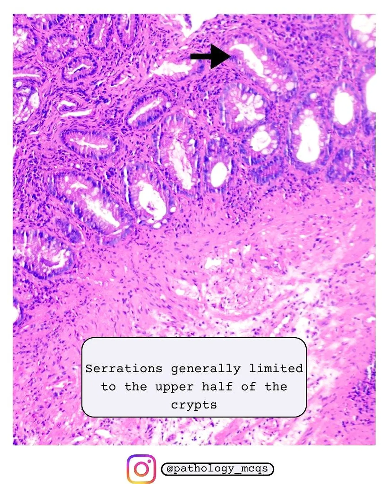 Superficial crypt serrations Photomicrograph of a hyperplastic polyp showing serrated crypt architecture with serrations limited to the upper half of the crypts.