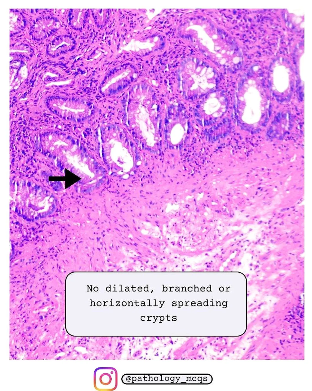 Preserved crypt base architecture Microscopic view of hyperplastic polyp pathology showcasing serrated crypt architecture with straight, narrow crypt bases and no dilation or branching.