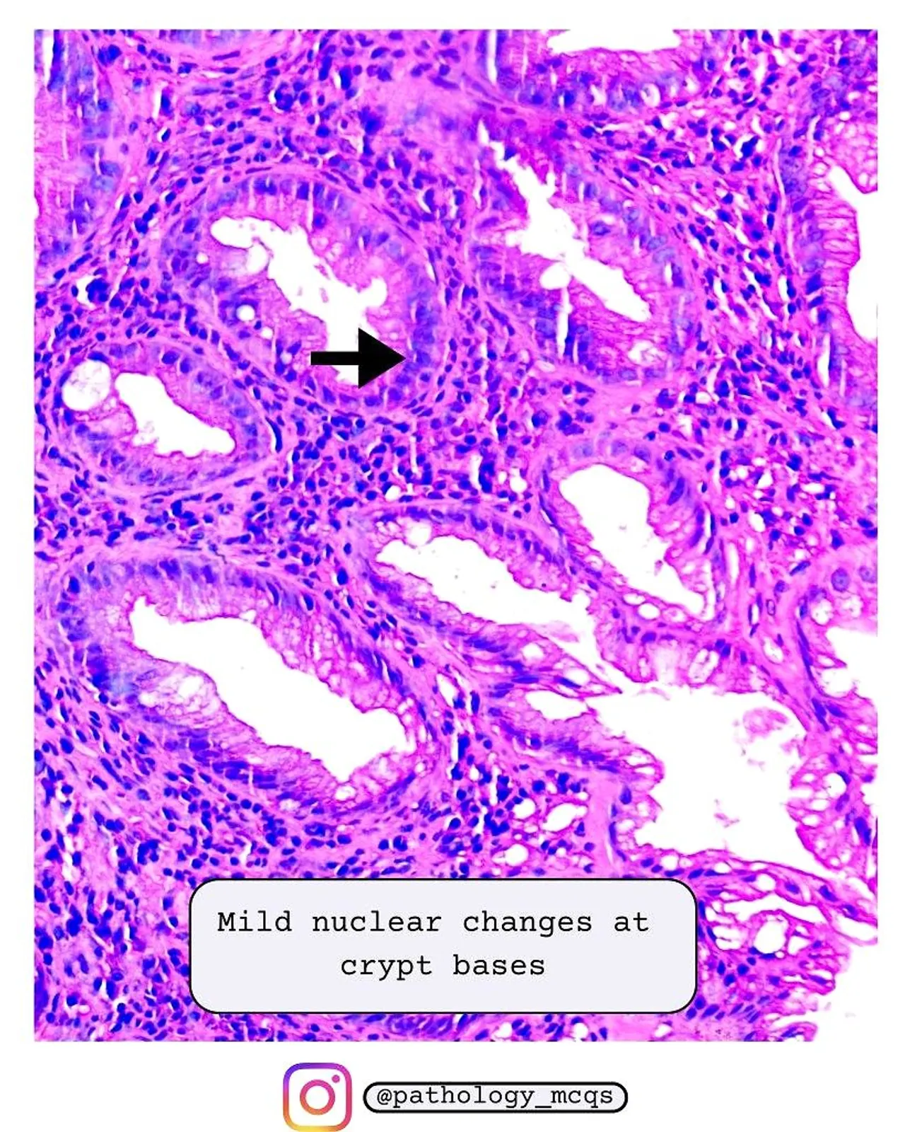 Mild nuclear enlargement Histological view of a hyperplastic polyp showing mild nuclear changes at the crypt bases with serrated architecture.