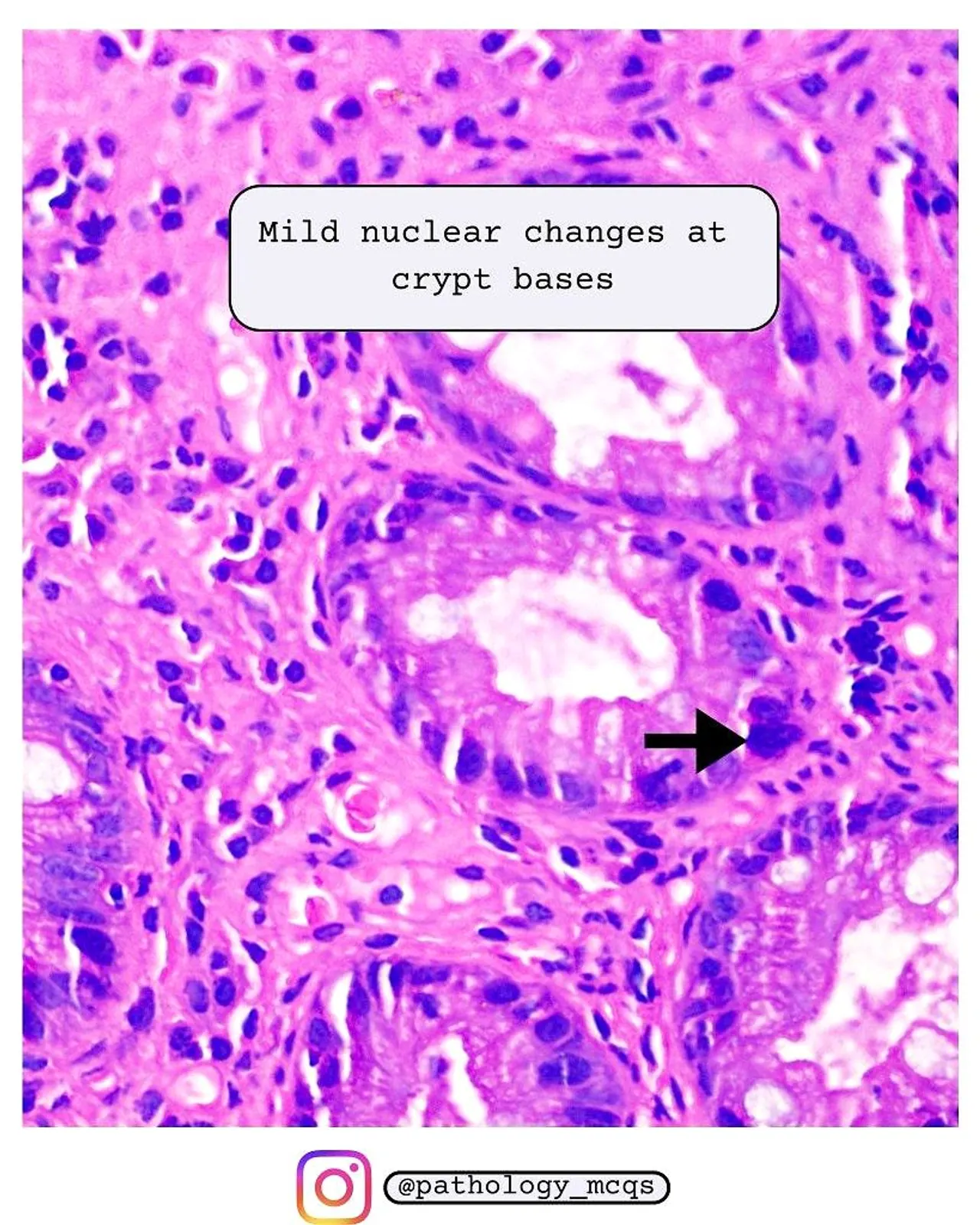 High-power crypt base view Microscopic view showing mild nuclear changes at the bases of crypts in a hyperplastic polyp, with a pink and purple stained background.