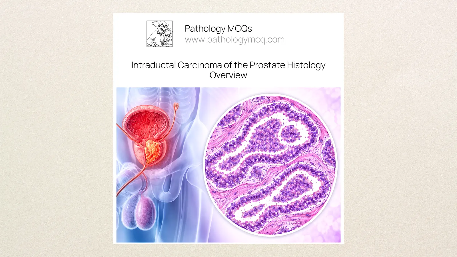 Intraductal Carcinoma of the Prostate (IDC‑P): Histology, Diagnostic Criteria and Prognostic Significance