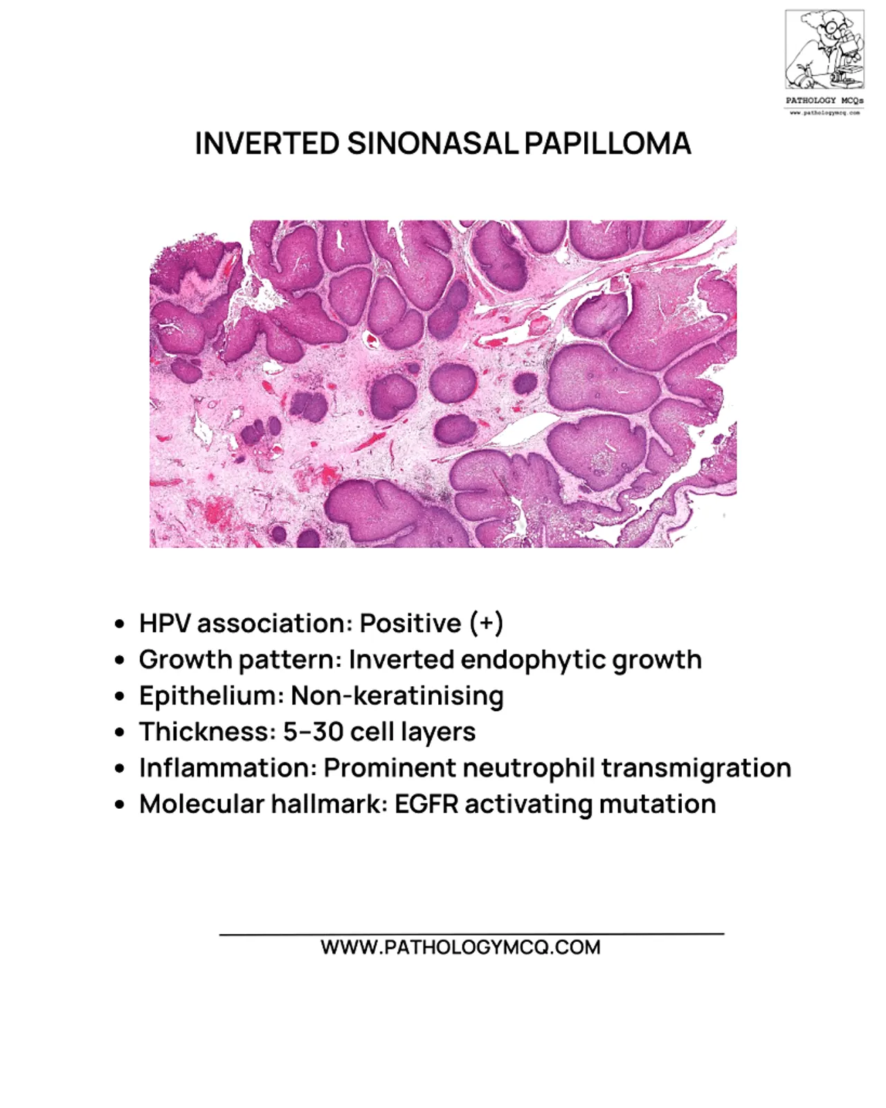 Inverted sinonasal papilloma histology showing endophytic growth of non-keratinizing epithelium