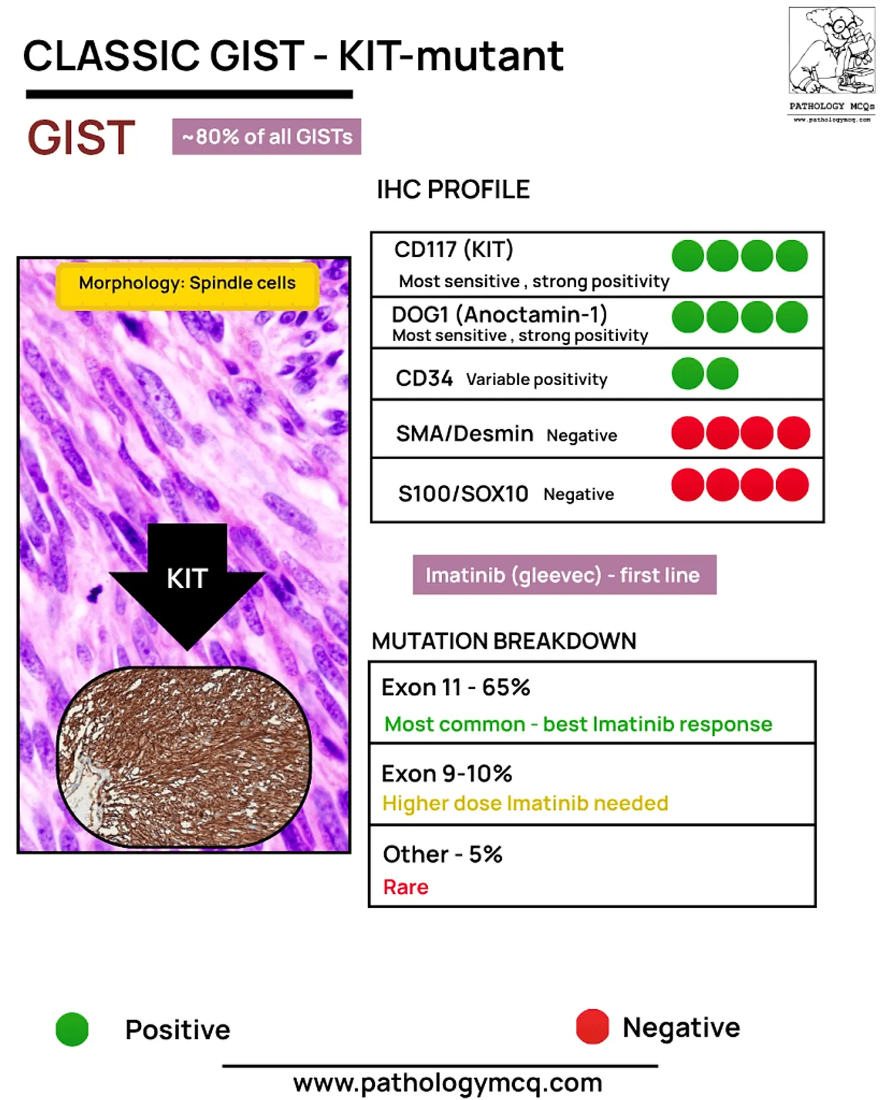Infographic on Classic GIST - KIT-mutant, detailing morphology, IHC profile, and mutation breakdown with visuals of spindle cells and KIT expression.
