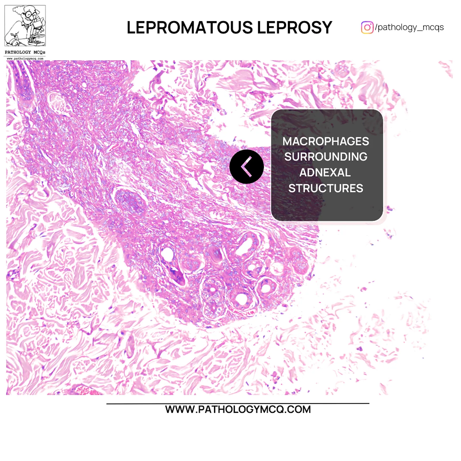 Foamy macrophages surrounding adnexal structures in lepromatous leprosy histopathology