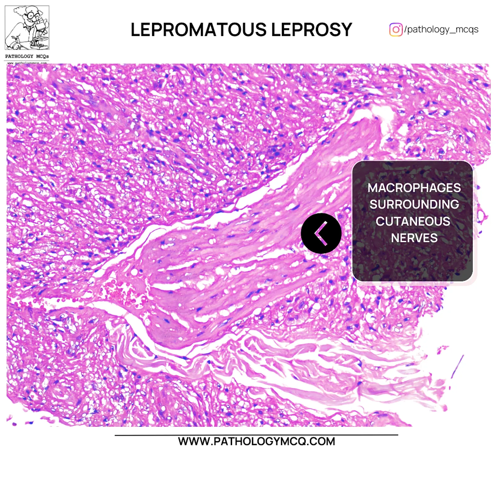Foamy macrophages surrounding cutaneous nerves in lepromatous leprosy histopathology