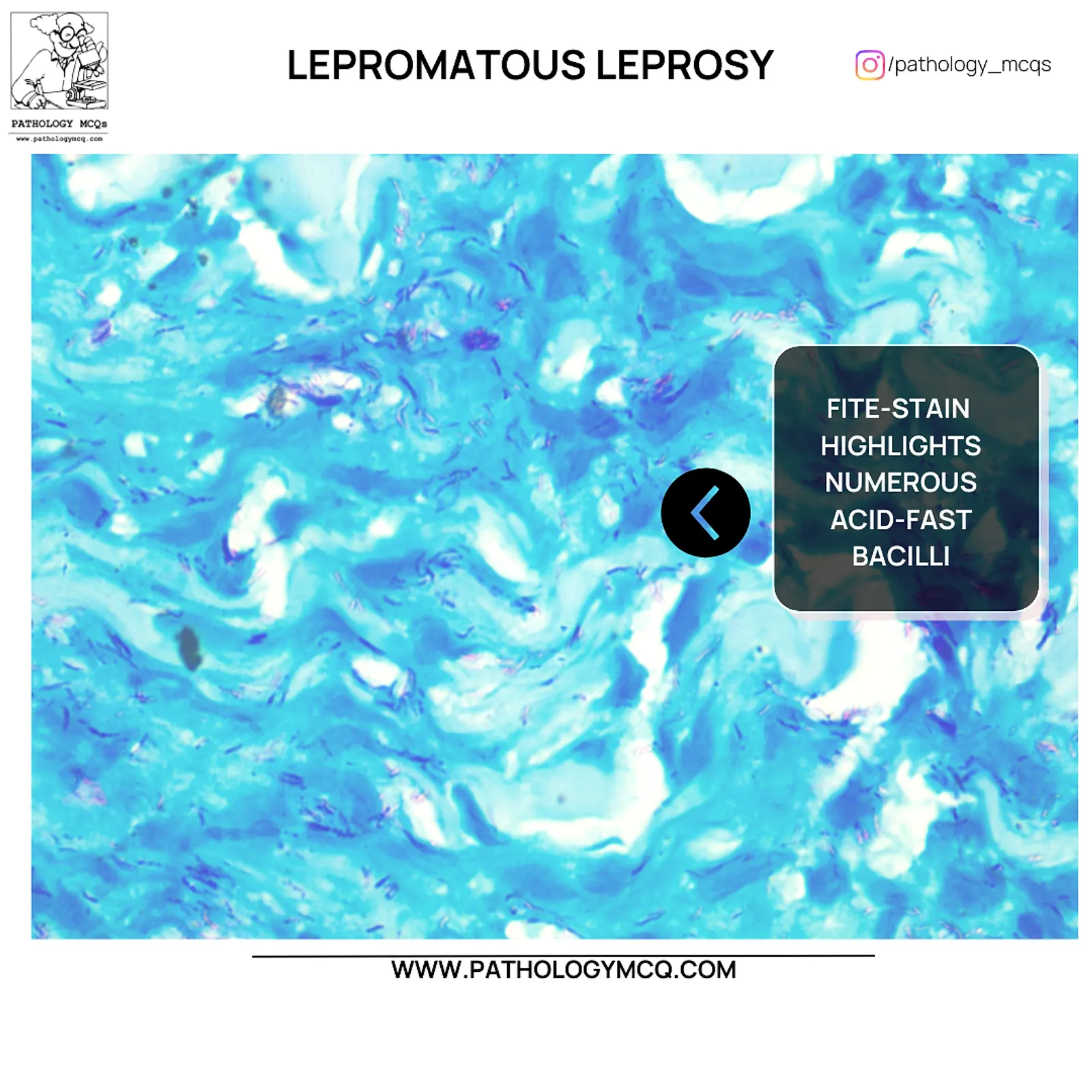 Numerous acid fast bacilli in lepromatous leprosy histopathology