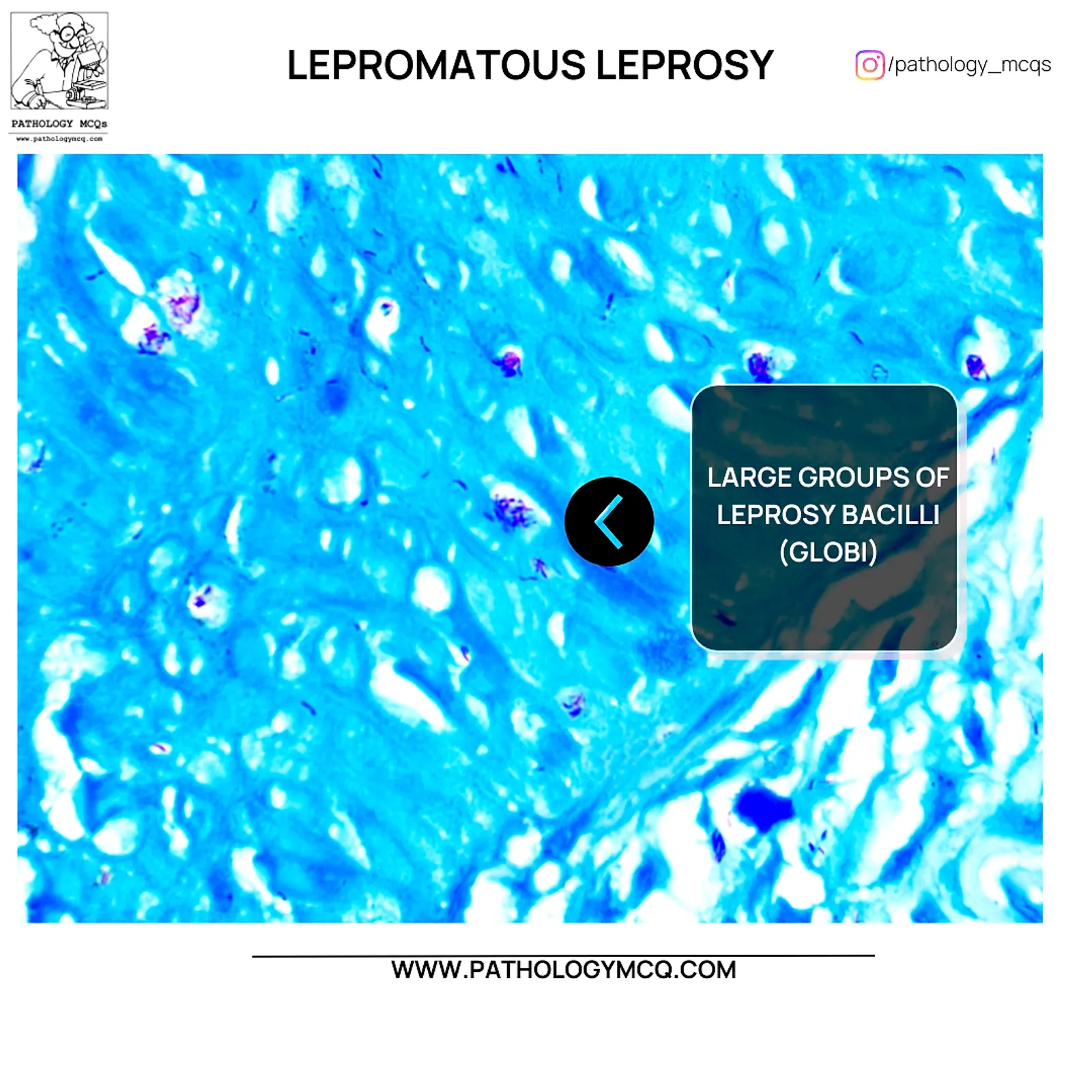 Large bacillary aggregates globi in lepromatous leprosy histopathology