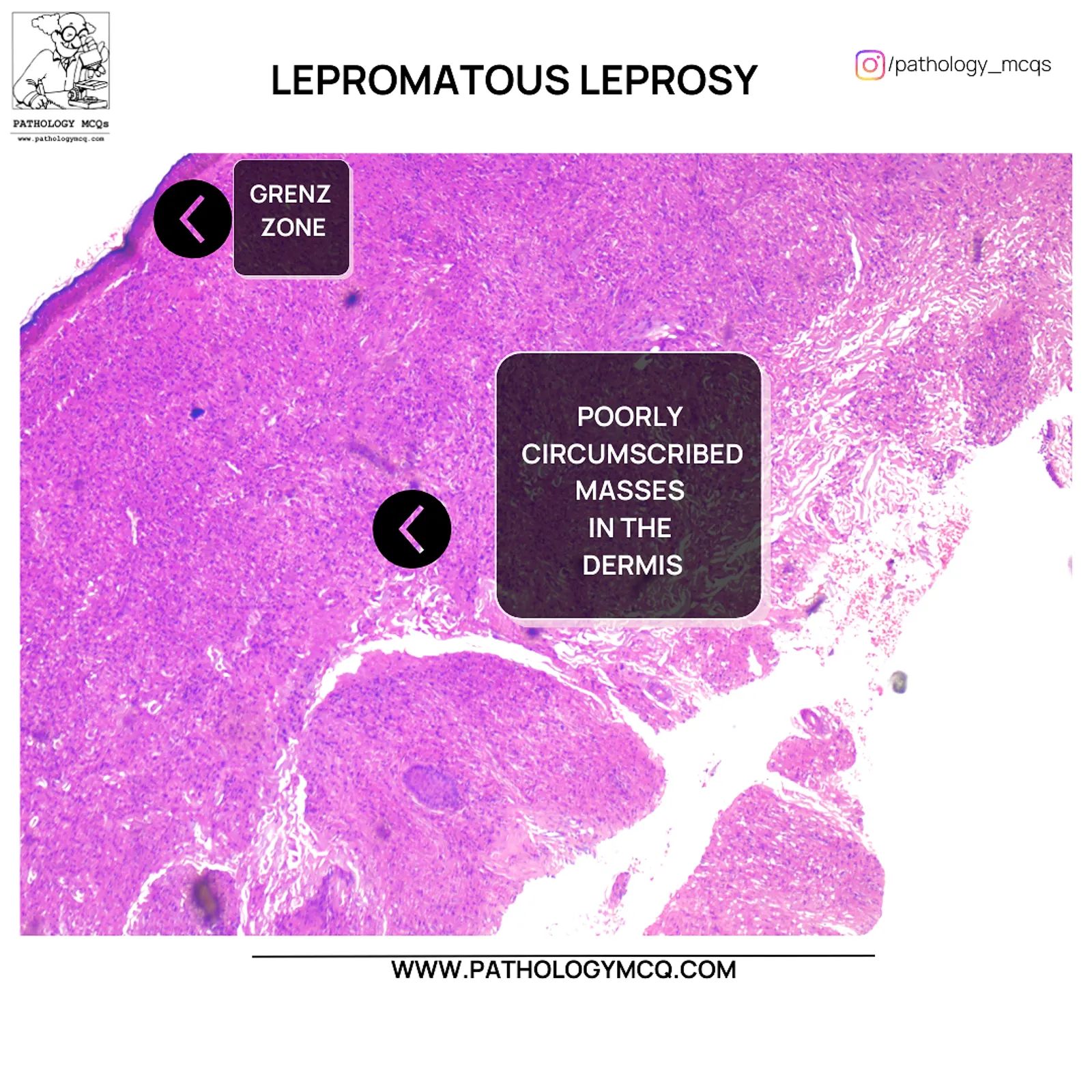 Grenz zone separating epidermis from dermal infiltrate in lepromatous leprosy