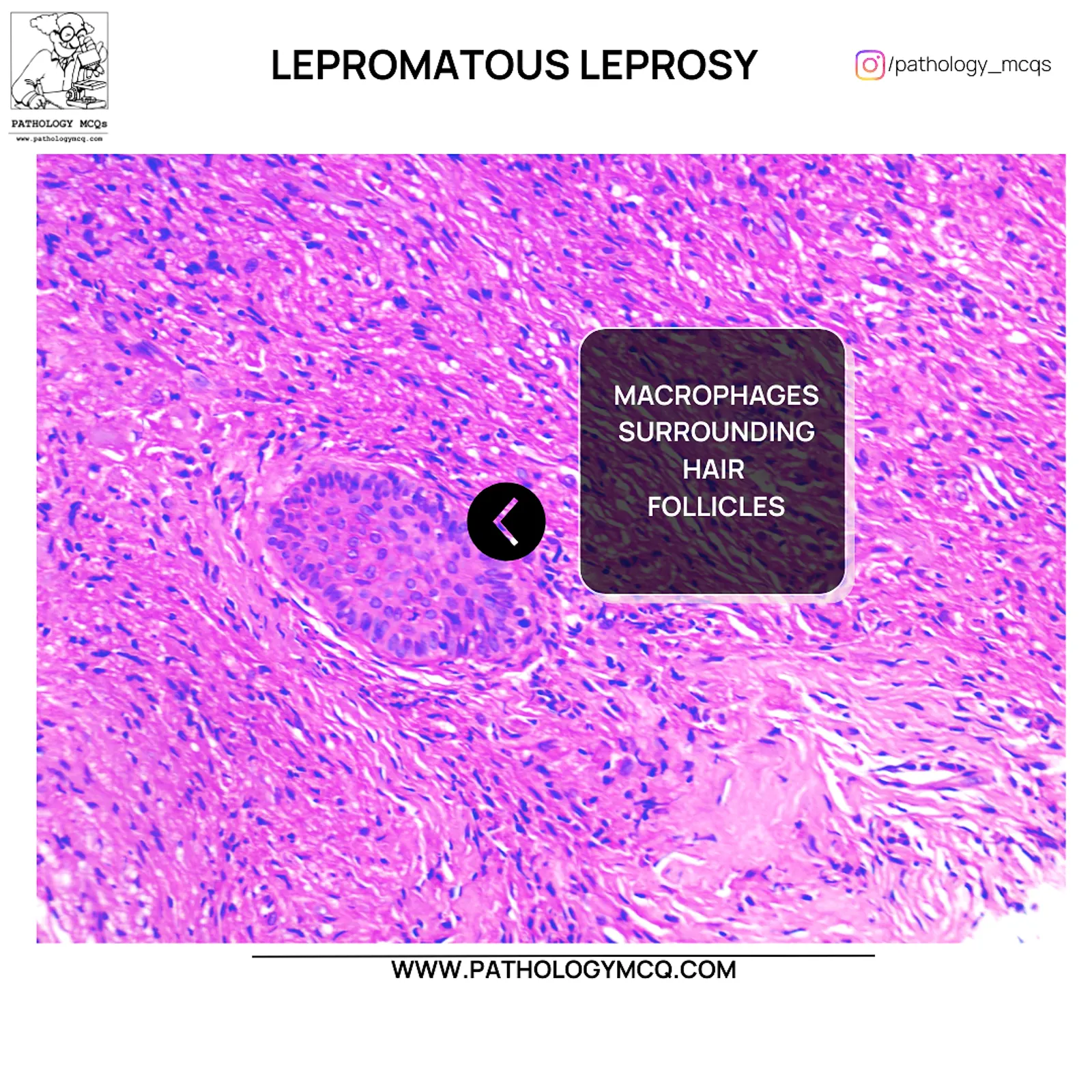 Foamy macrophages surrounding hair follicles in lepromatous leprosy histopathology