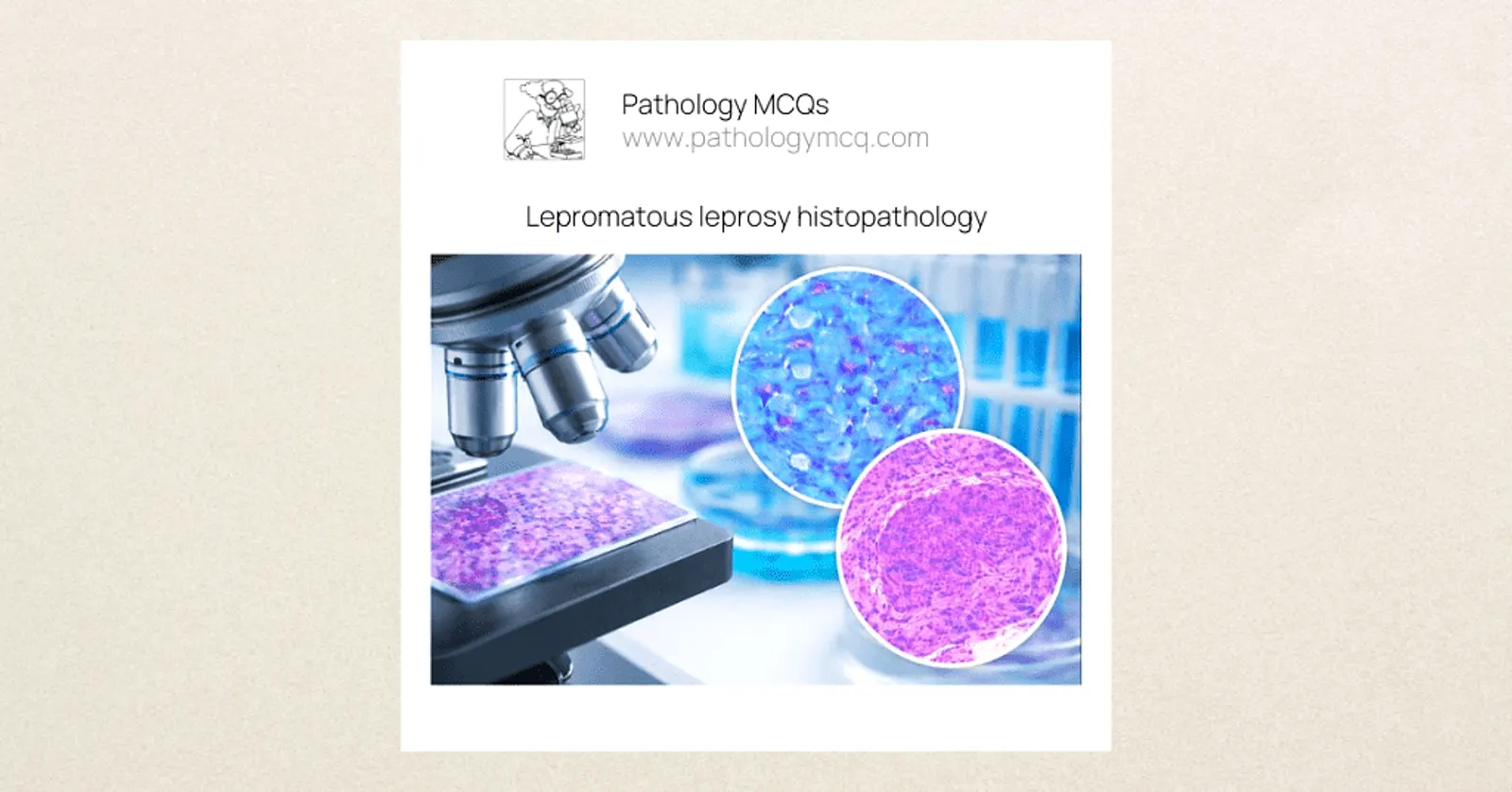 Lepromatous leprosy histopathology microscopic overview
