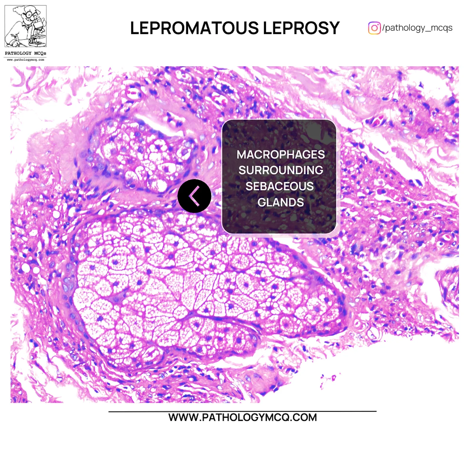 Macrophage infiltration of sebaceous glands in lepromatous leprosy histopathology