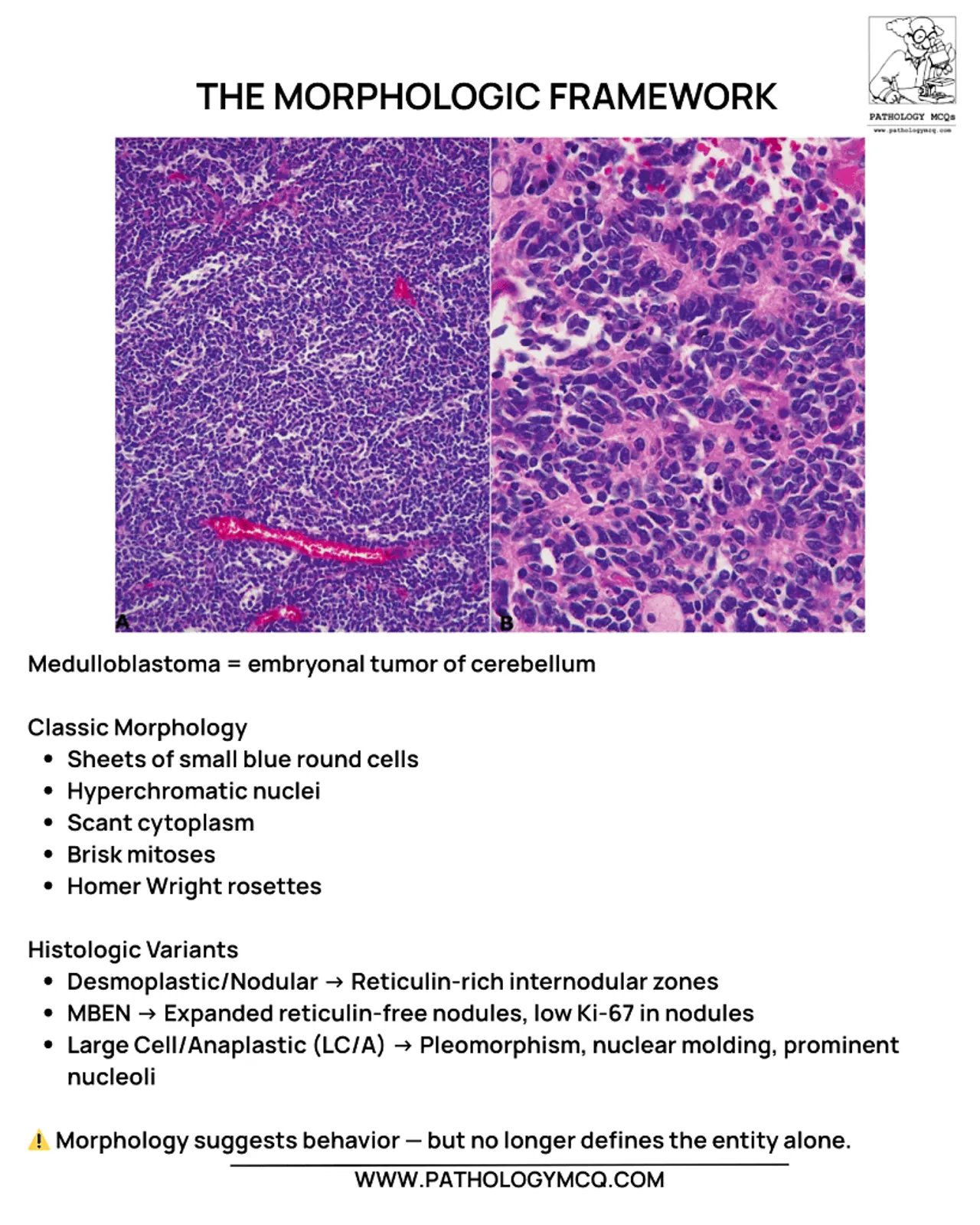 Classic medulloblastoma pathology showing sheets of small round blue cells with hyperchromatic nuclei and Homer Wright rosettes on H&E stain