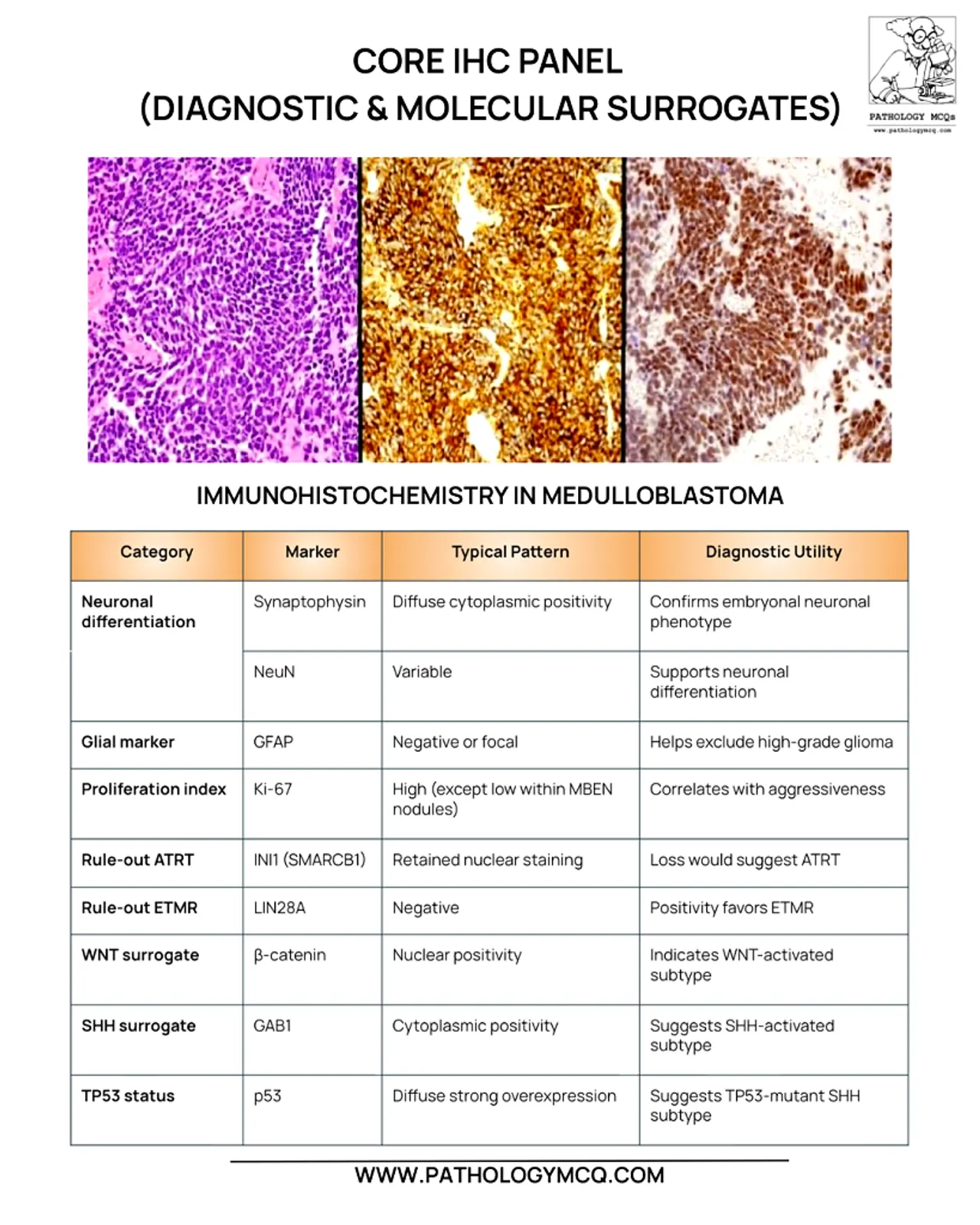 An educational chart detailing the core immunohistochemistry panel for diagnosing medulloblastoma, featuring images of histological samples and a table summarizing various markers, patterns, and their diagnostic utilities.