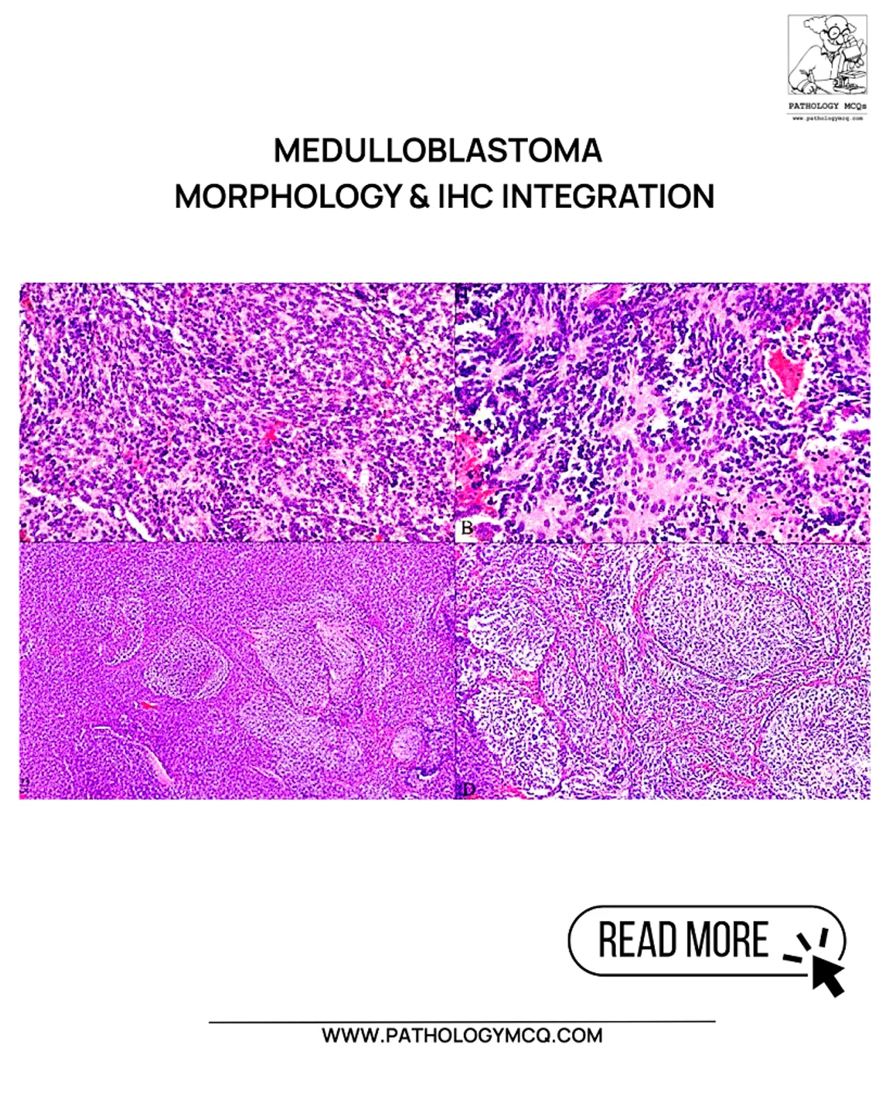 Medulloblastoma pathology showing classic, desmoplastic, and large cell anaplastic histologic variants on H&E