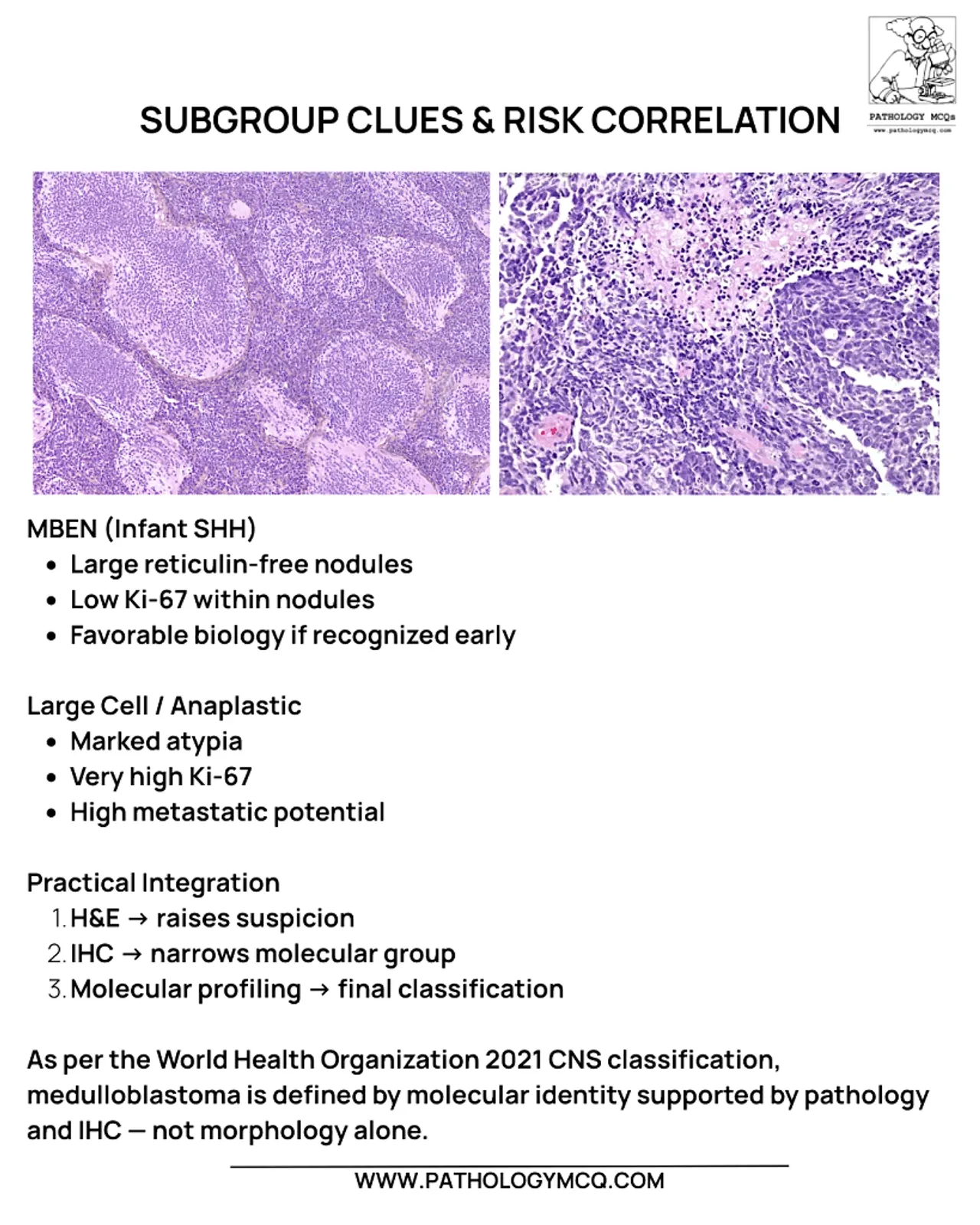 Medulloblastoma pathology showing MBEN with large reticulin-free nodules and large cell anaplastic variant with marked atypia and high mitotic activity