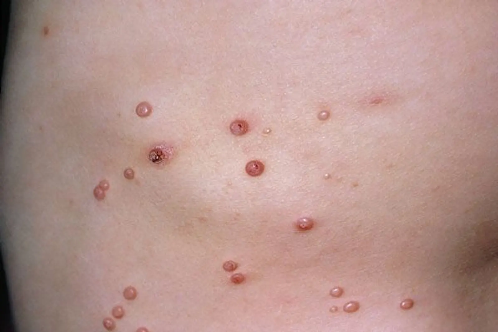 Clinical photo of multiple pearly umbilicated papules characteristic of molluscum contagiosum.