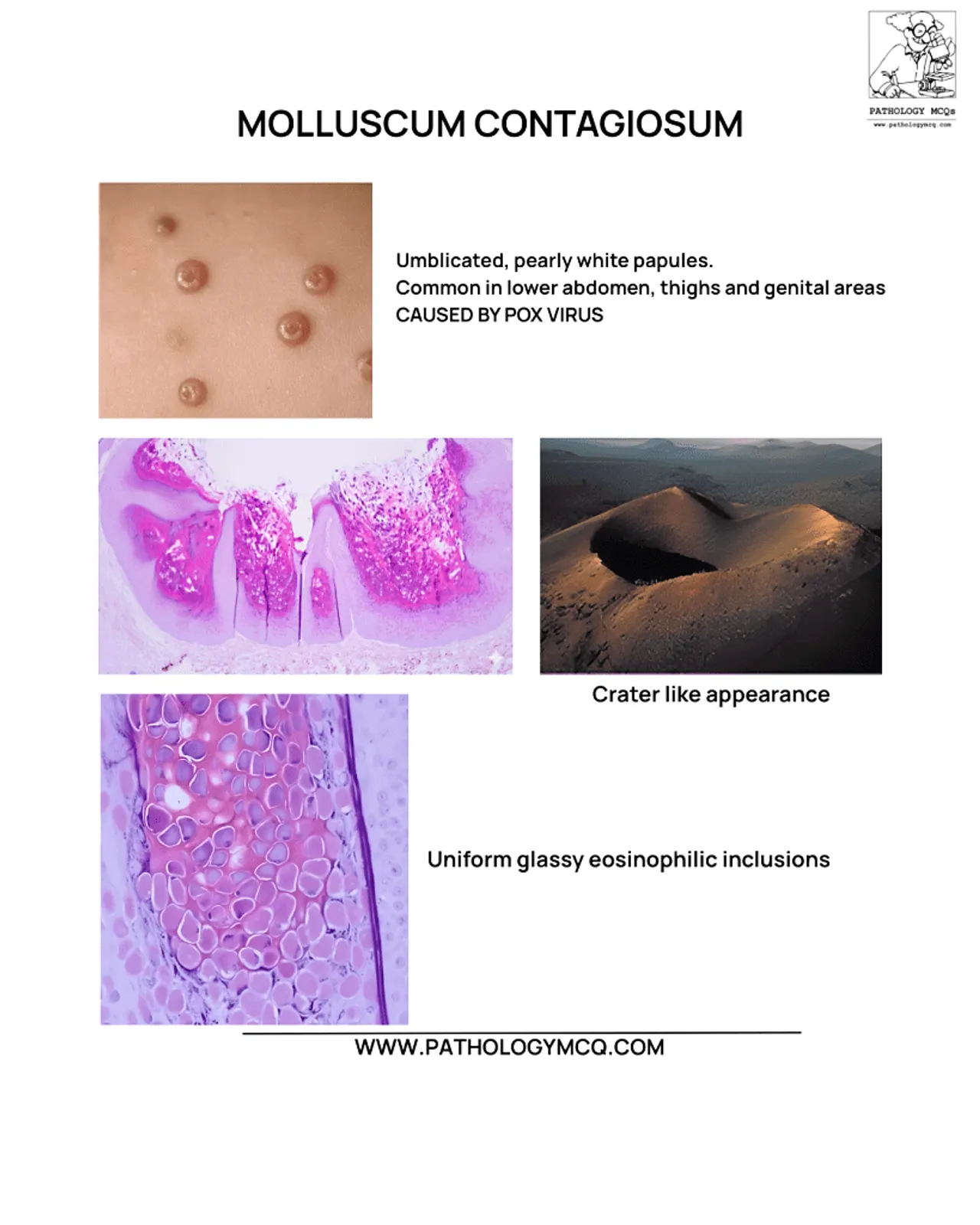 Molluscum contagiosum histopathology with pearly umbilicated papules and crateriform epidermal lesion.