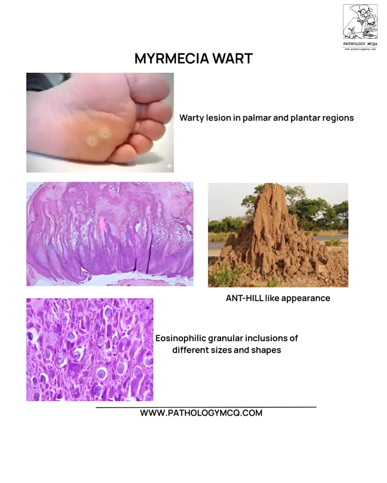 Comparison of molluscum contagiosum histopathology and myrmecia wart showing plantar papillomatous architecture and eosinophilic inclusions.