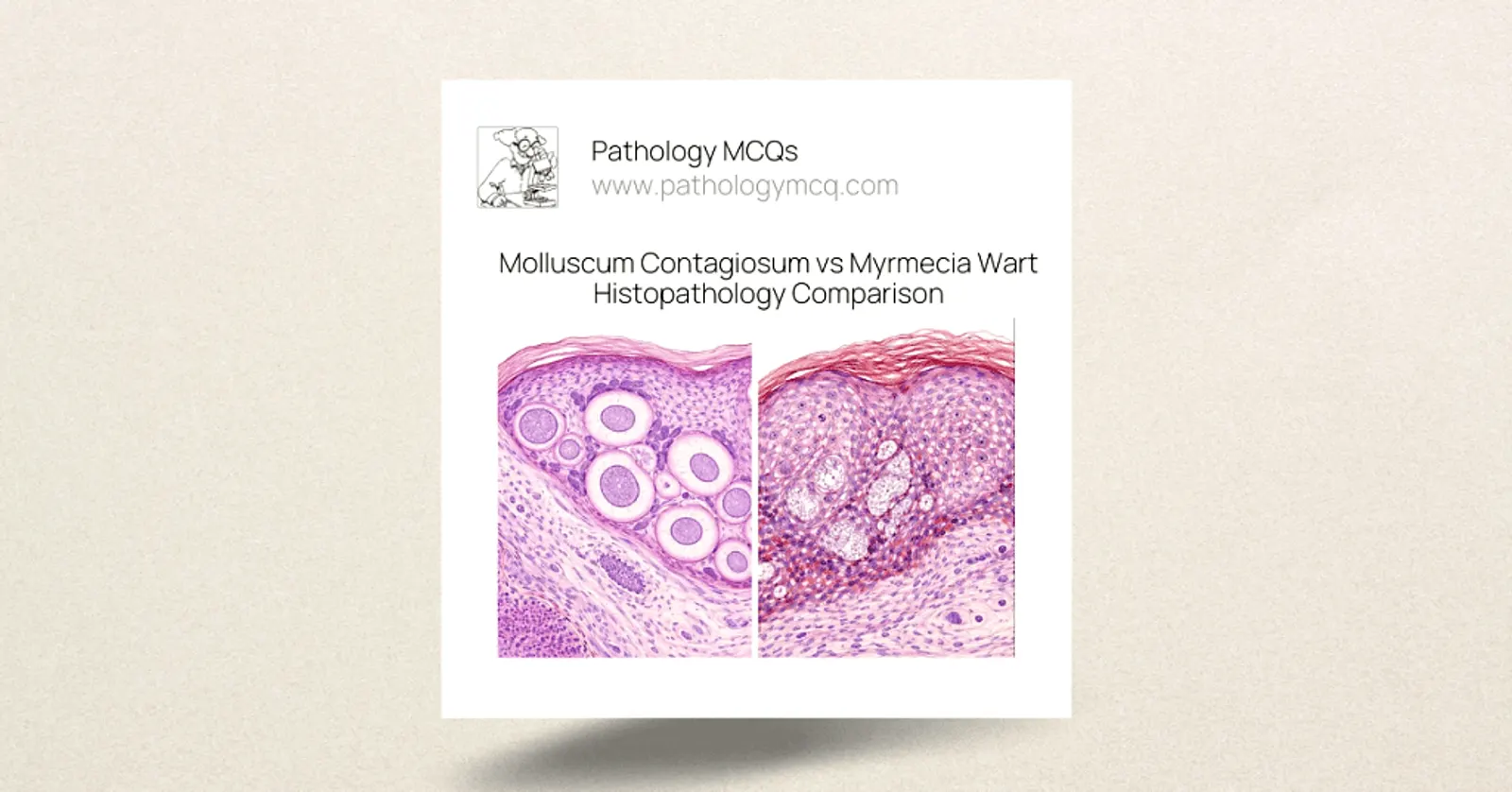 Molluscum contagiosum vs myrmecia wart histopathology showing crateriform lesion with molluscum bodies and papillomatous wart architecture

