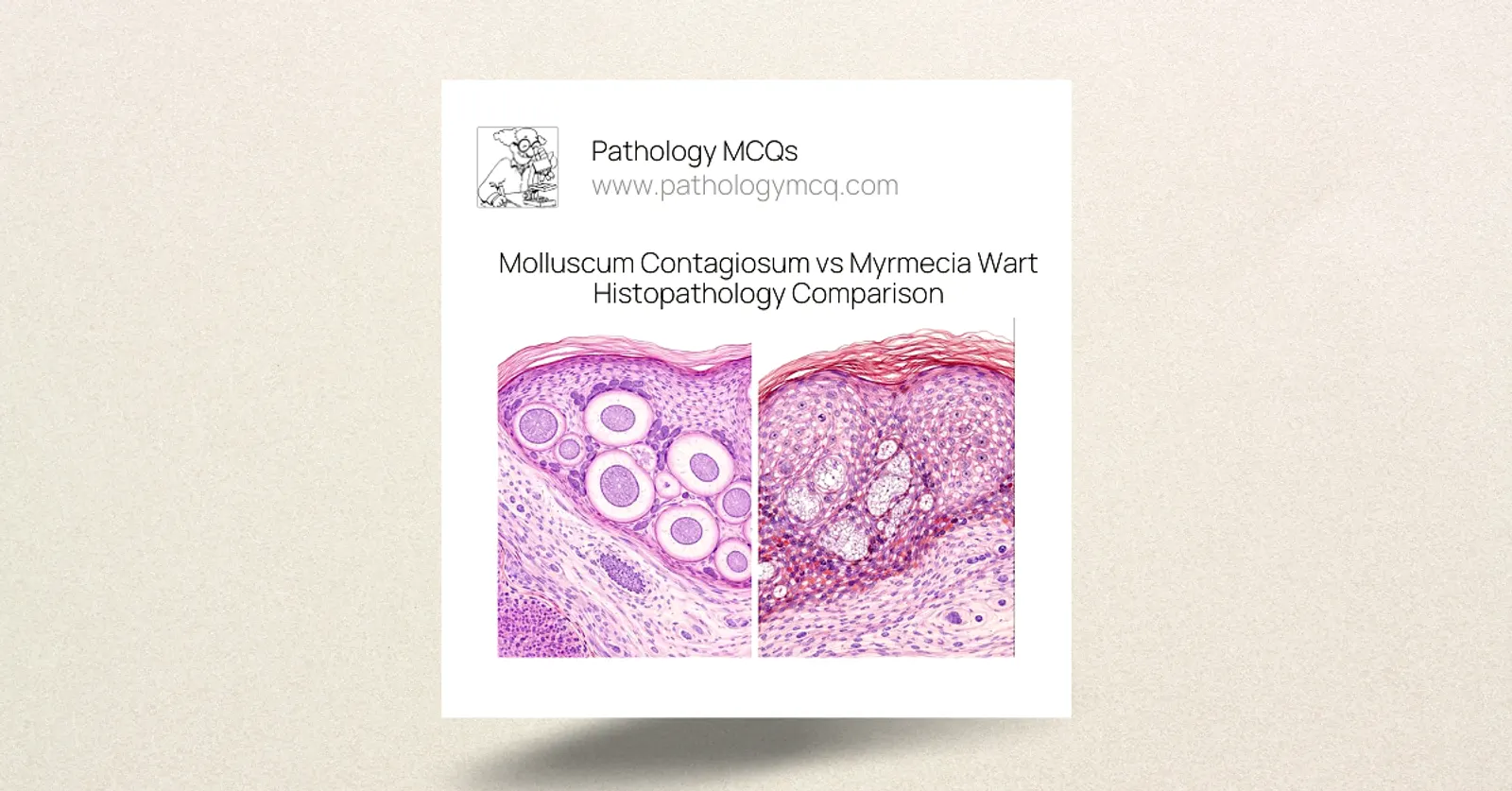 Molluscum Contagiosum vs Myrmecia Wart Histopathology | Diagnostic Clues &amp; MCQs