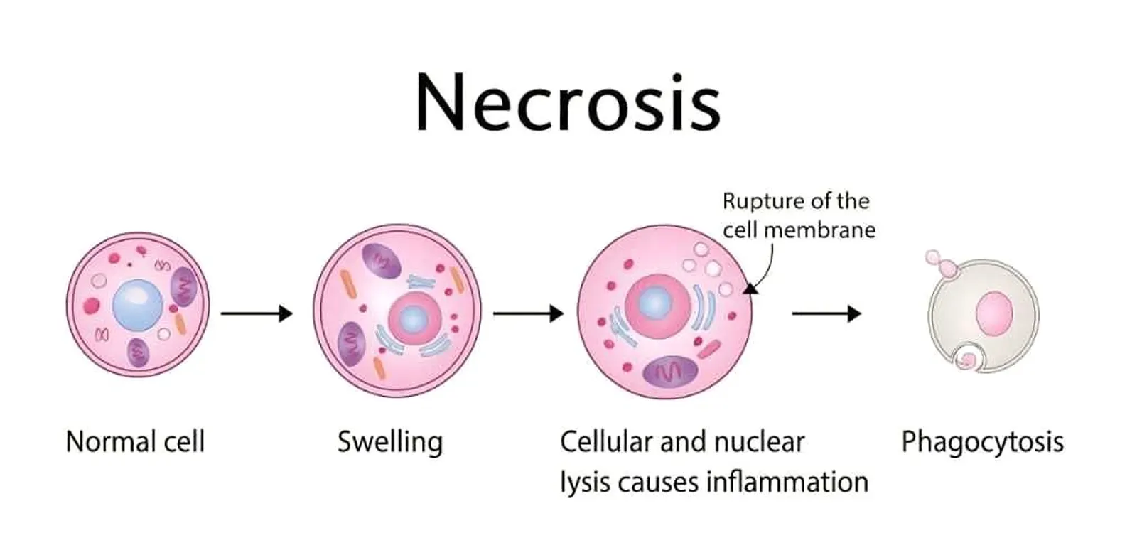 Medical illustration showing sequential stages of necrosis: normal cell, swelling, membrane rupture, inflammation, and final phagocytosis