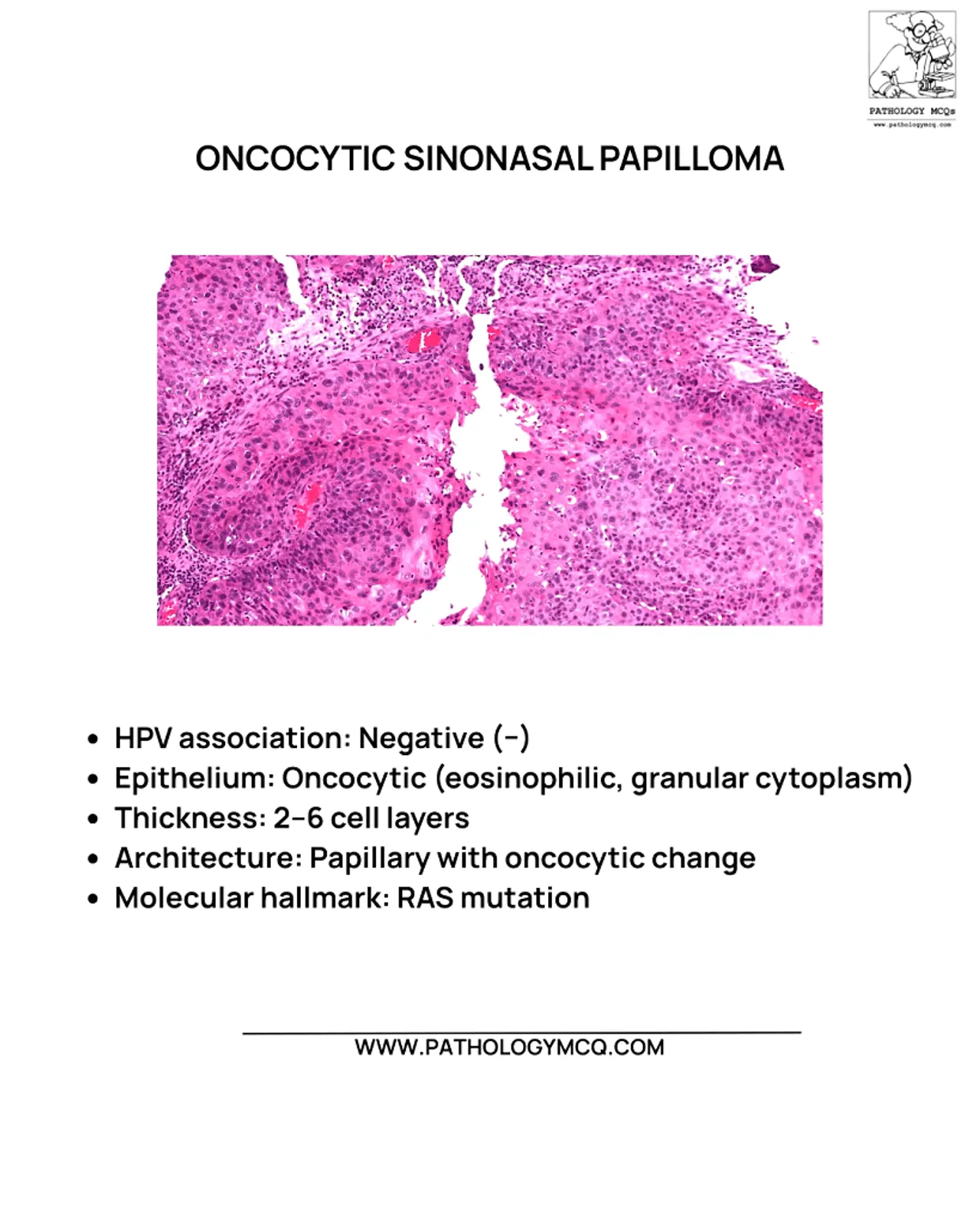 Oncocytic sinonasal papilloma histology showing eosinophilic granular oncocytic epithelium