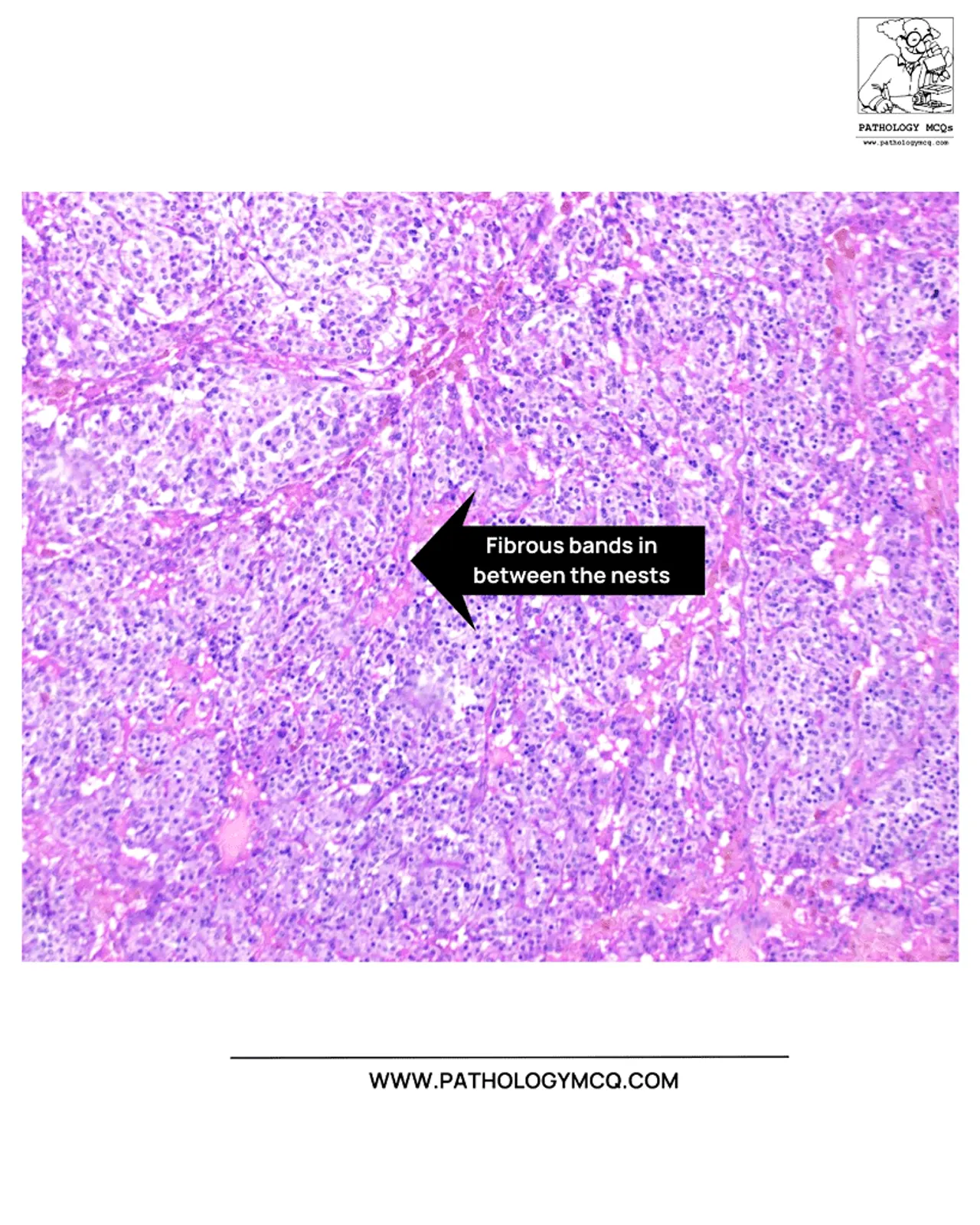Fibrocollagenous bands separating tumor nests in paraganglioma
