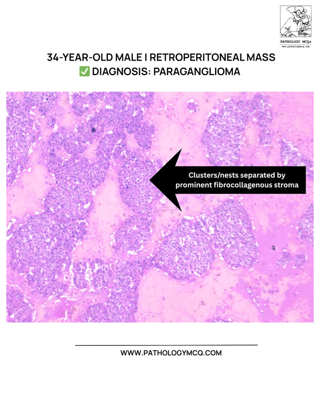 Low-power H&E section of paraganglioma showing cellular nests separated by fibrocollagenous stroma