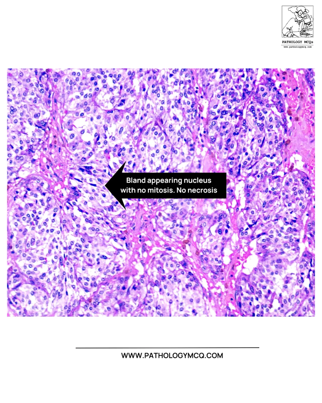 Nests and islands of tumor cells forming an organic pattern in paraganglioma