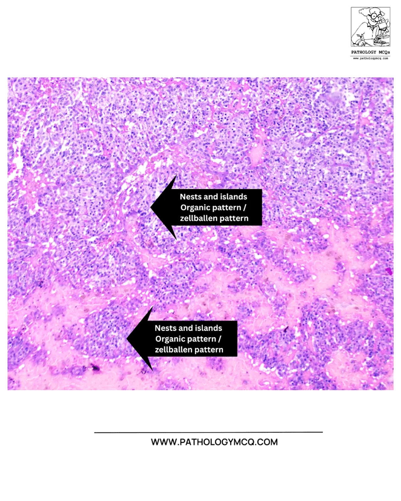 Zellballen architecture with nests and islands of neuroendocrine cells in paraganglioma