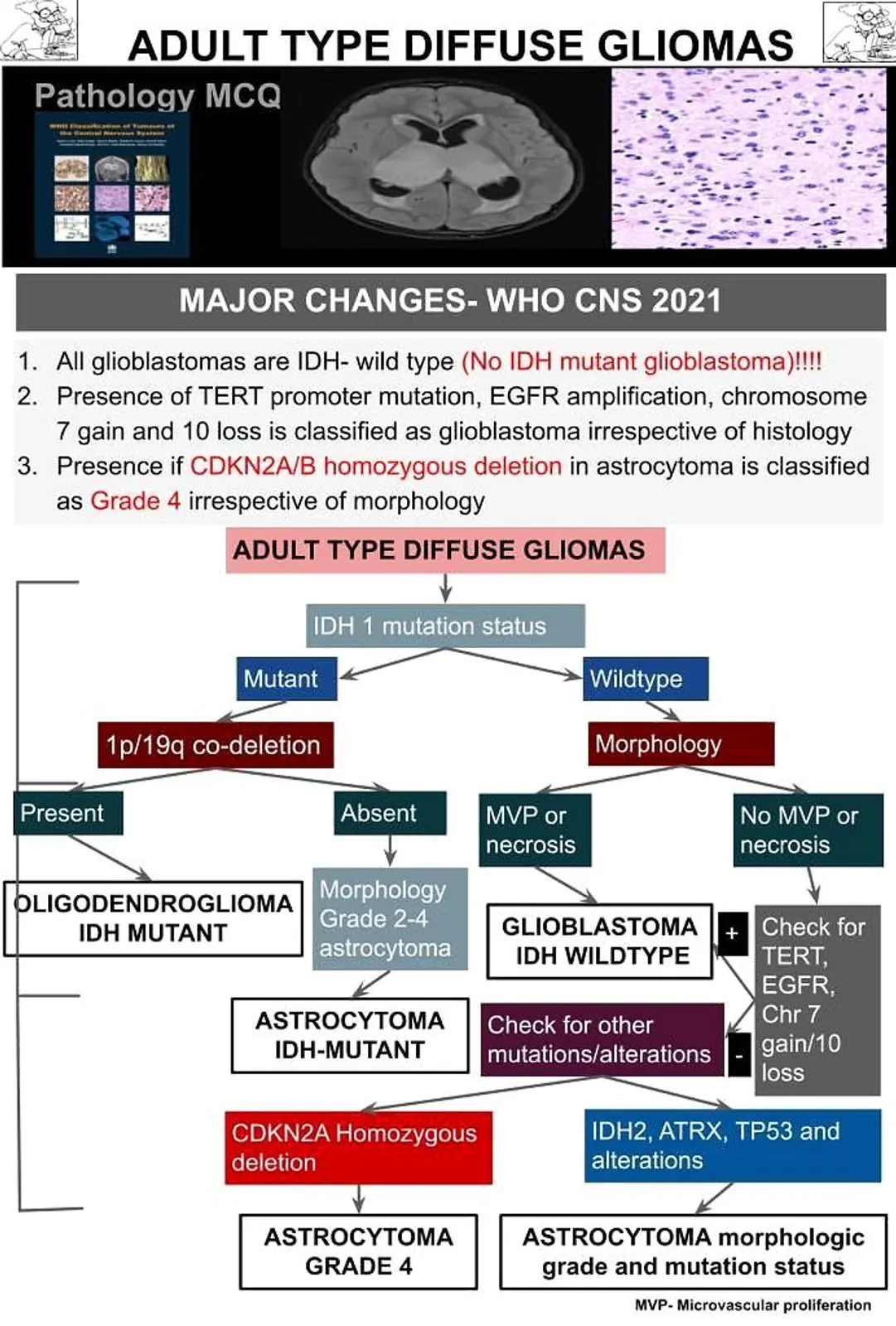 Astrocytoma - diagnostic algorithm based on 2021 CNS tumors- 5th edition