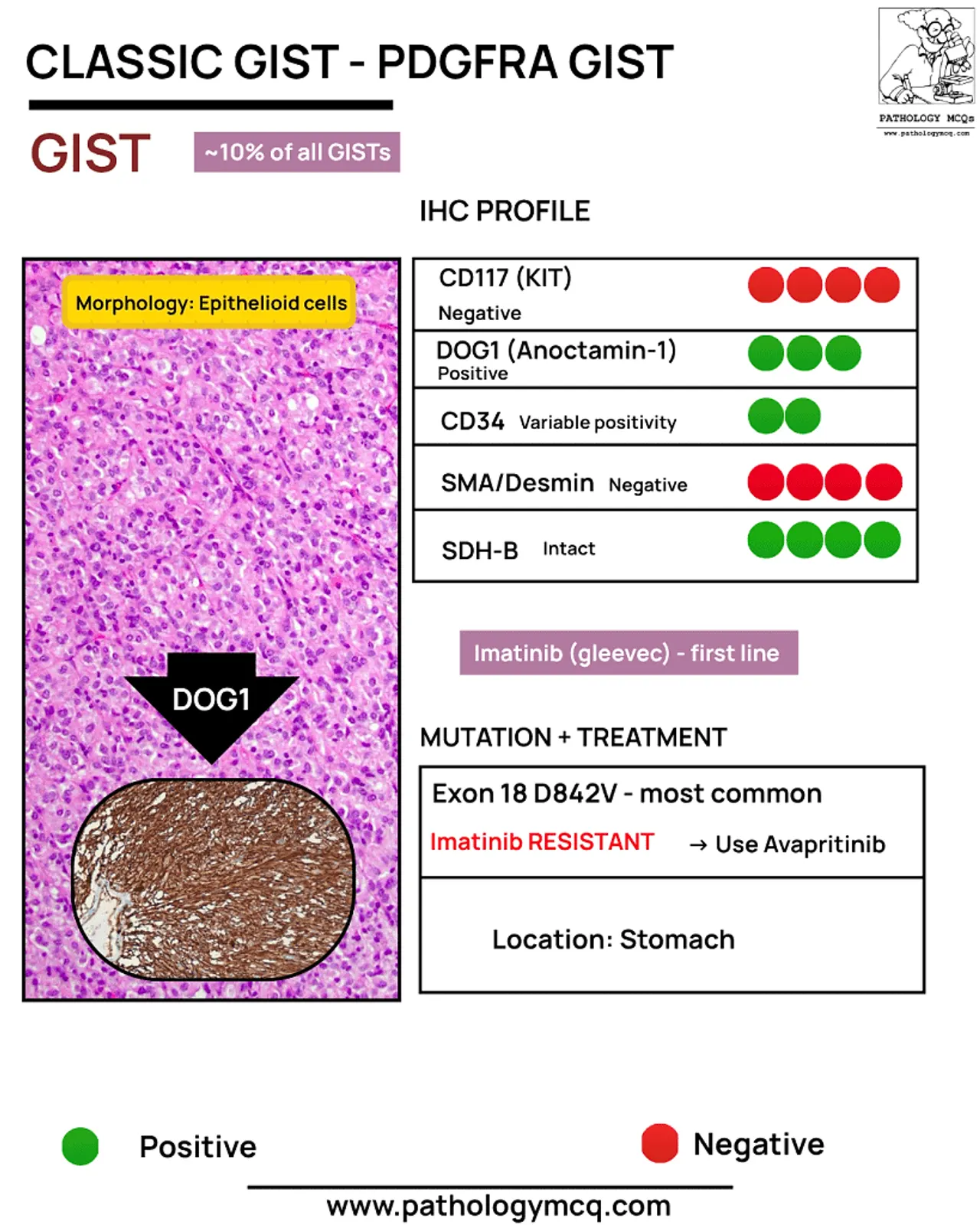 Infographic on Classic GIST (PDGFRA GIST) with histological image showing epitheloid cells, IHC profile results, mutation information, and treatment recommendations for GIST located in the stomach.