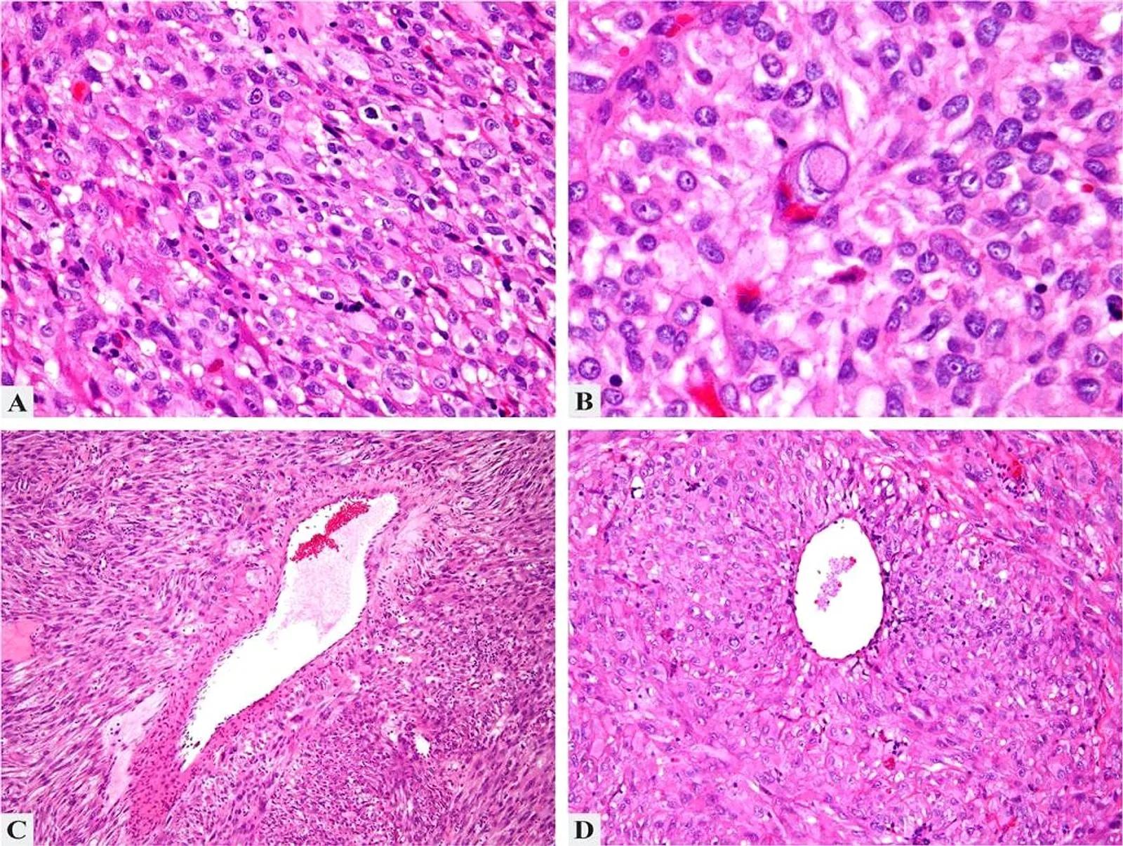 High-power photomicrograph showing epithelioid cells with clear to granular cytoplasm around vessels in a classic perivascular epithelioid cell tumor.
