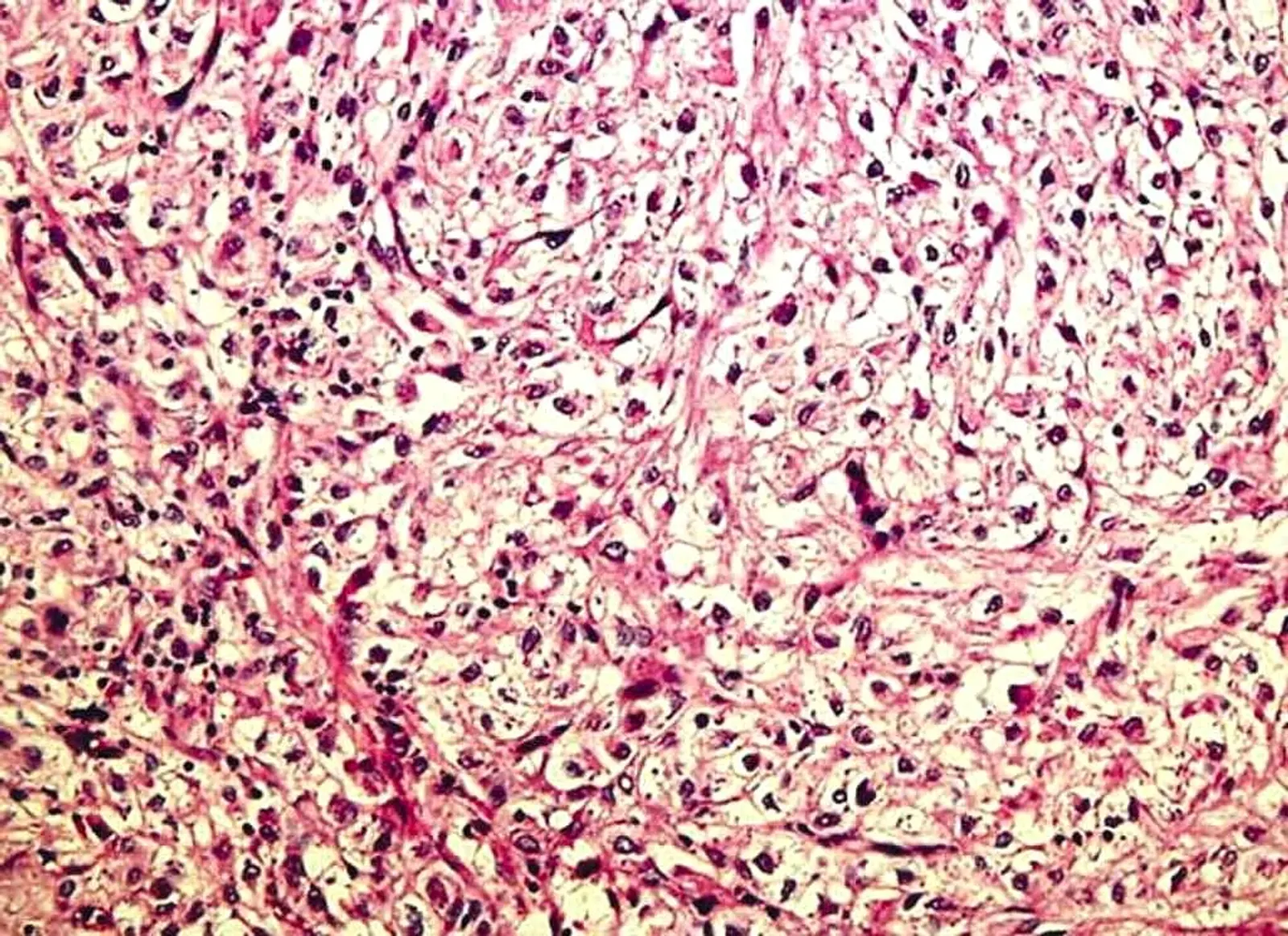 High-power image of LAM-like perivascular epithelioid cell tumor showing spindle cells around thick-walled blood vessels.