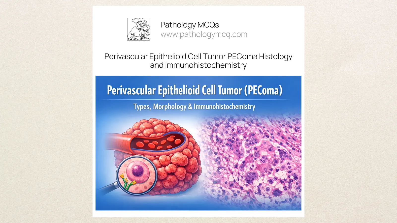 Perivascular Epithelioid Cell Tumor (PEComa) – Types, Morphology and Immunohistochemistry