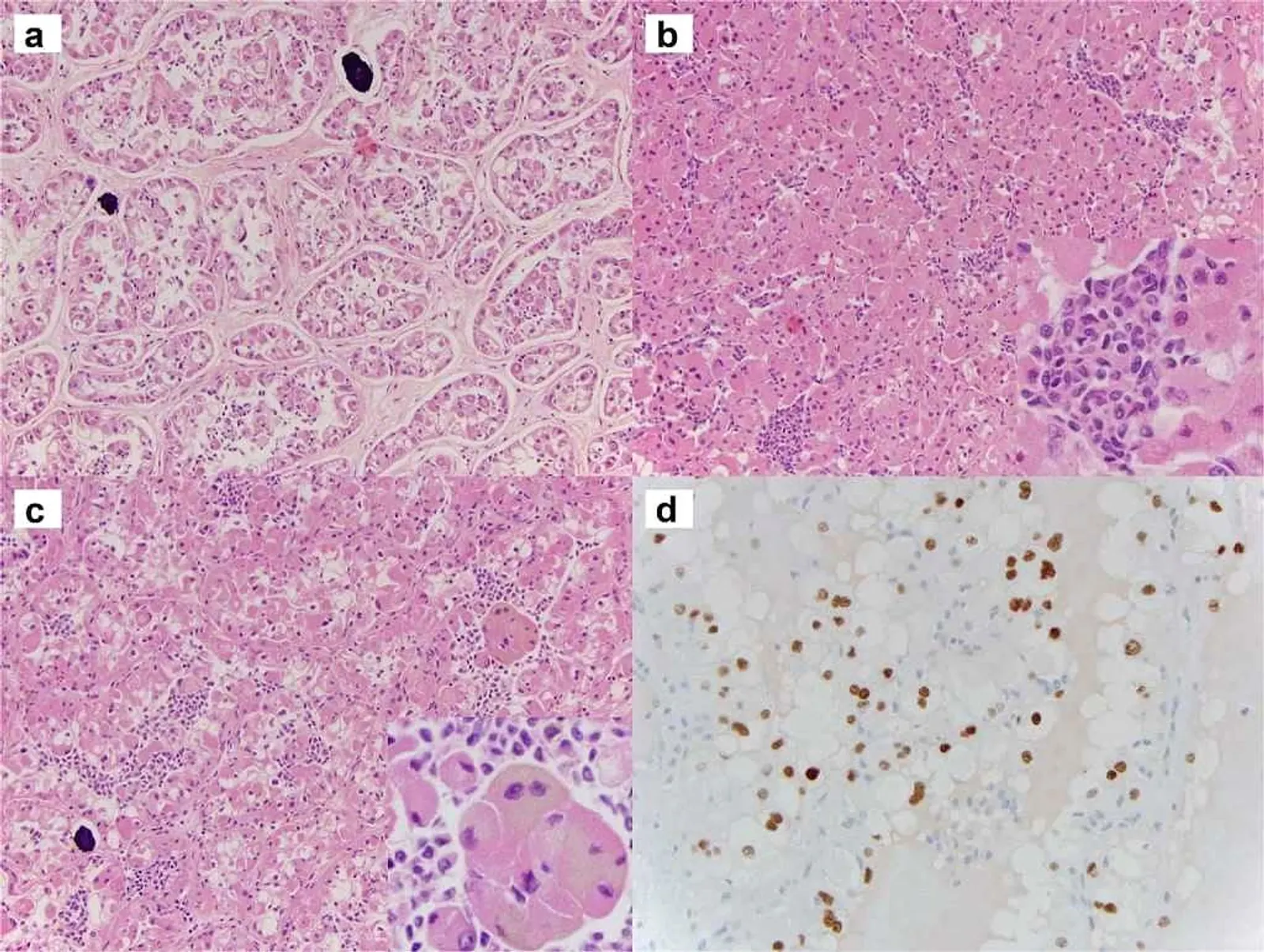Histologic panels illustrating nested clear cell architecture and strong nuclear TFE3 staining in TFE3 translocation-associated perivascular epithelioid cell tumor.
