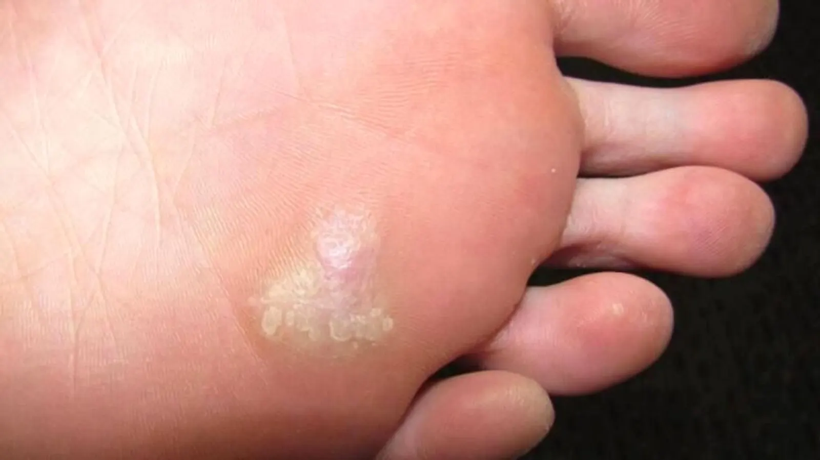 Close-up of plantar wart on sole, representing HPV-associated myrmecia wart.