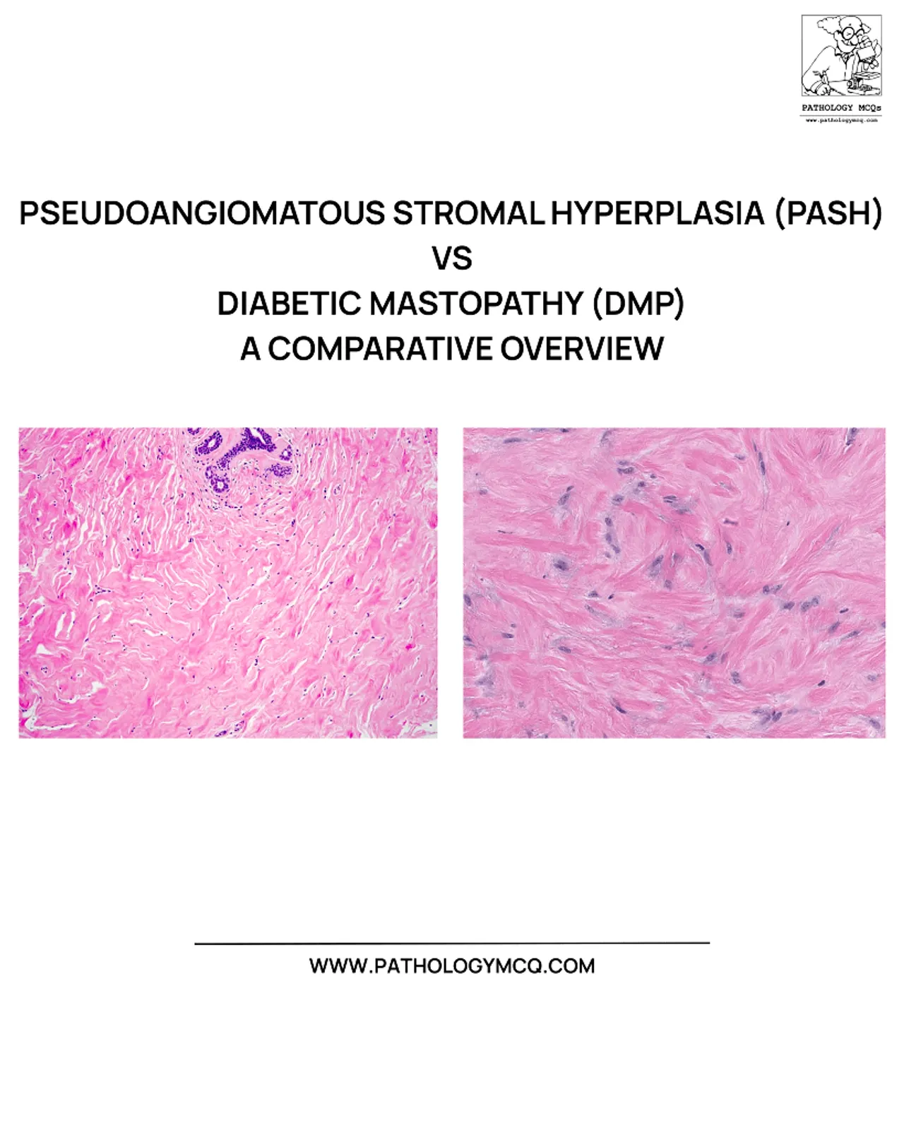 Clinical schematic comparing pseudoangiomatous stromal hyperplasia vs diabetic mastopathy showing circumscribed rubbery PASH mass and hard ill-defined diabetic mastopathy lesion.

