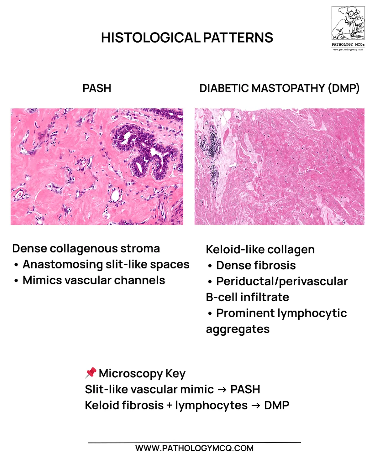 Comparative histology overview showing pseudoangiomatous stromal hyperplasia with stromal slits alongside diabetic mastopathy with dense collagenous fibrosis.