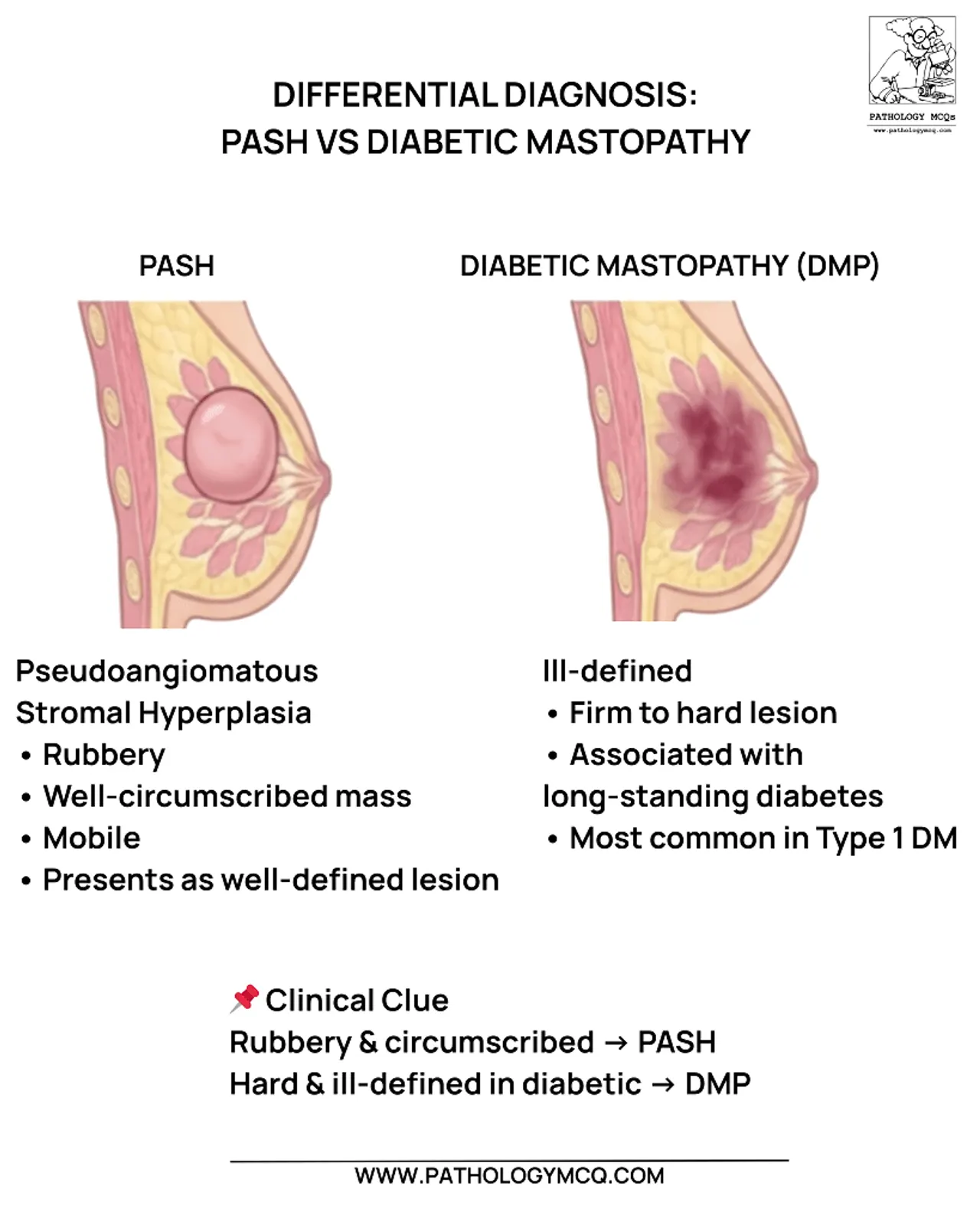 Side-by-side histology panels of pseudoangiomatous stromal hyperplasia vs diabetic mastopathy highlighting slit-like spaces in PASH and keloid-like fibrosis with lymphocytic aggregates in diabetic mastopathy.