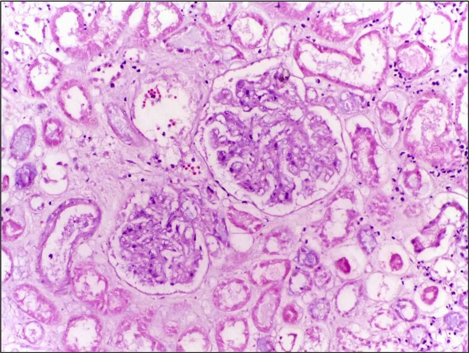 Coagulative necrosis renal infarct histology H&E