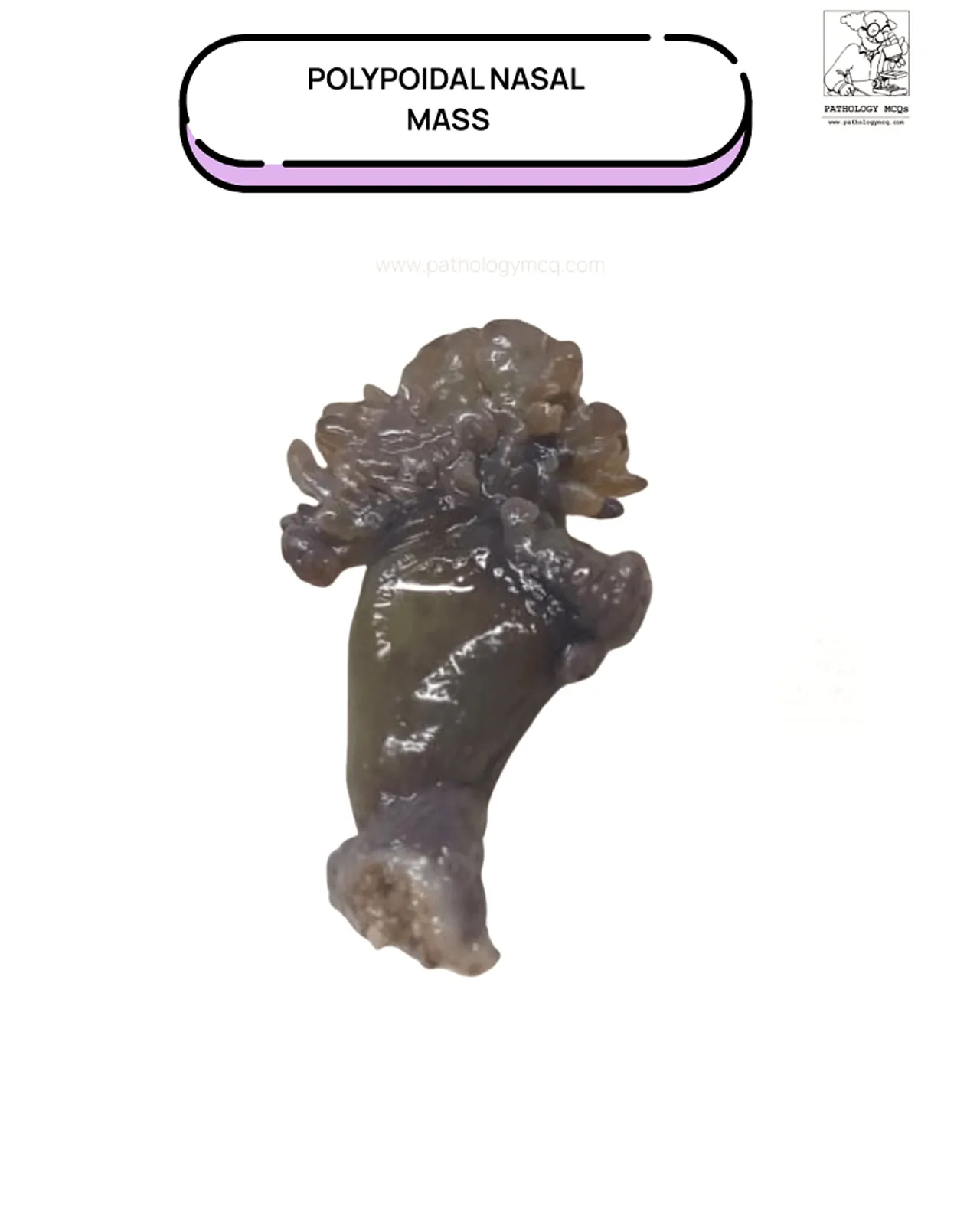 Polypoidal rhinosporidiosis mass