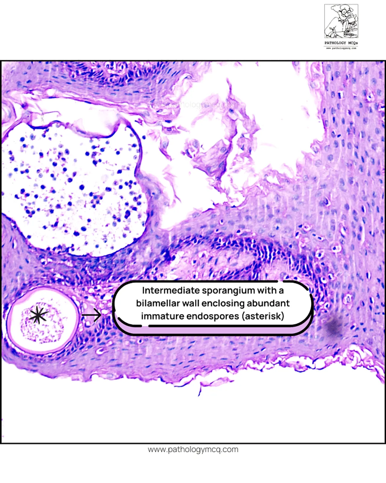 Intermediate sporangium of Rhinosporidium seeberi