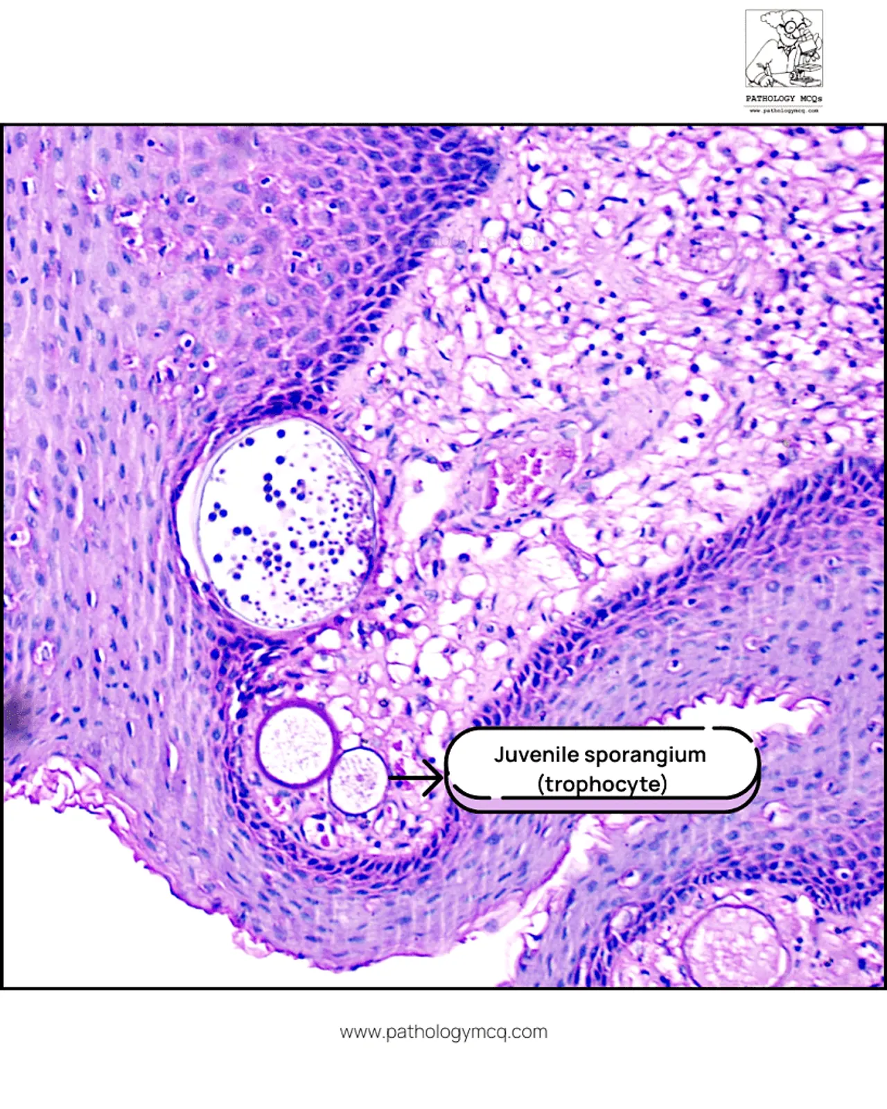 Juvenile trophocyte stage of rhinosporidiosis