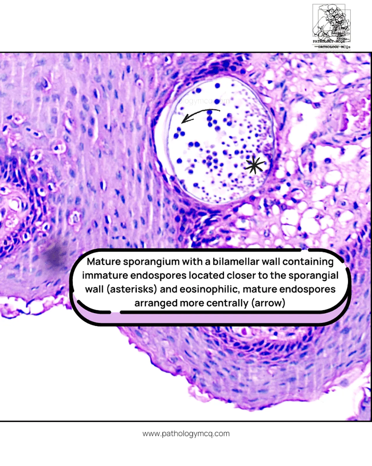 Mature sporangium with endospores