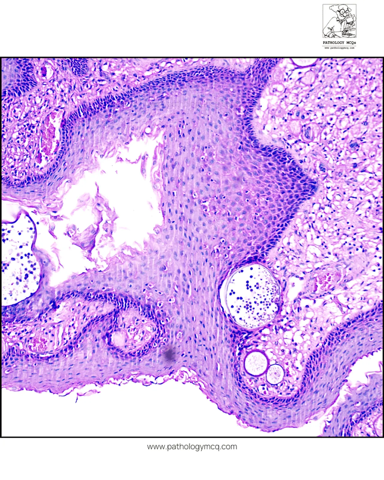 Squamous mucosa with sporangia