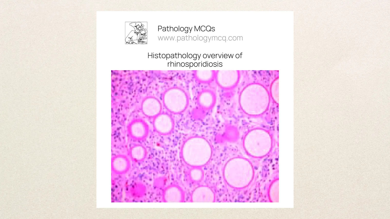 Rhinosporidiosis Case Study: Clinical Features, Life Cycle &amp; Histopathology With MCQs