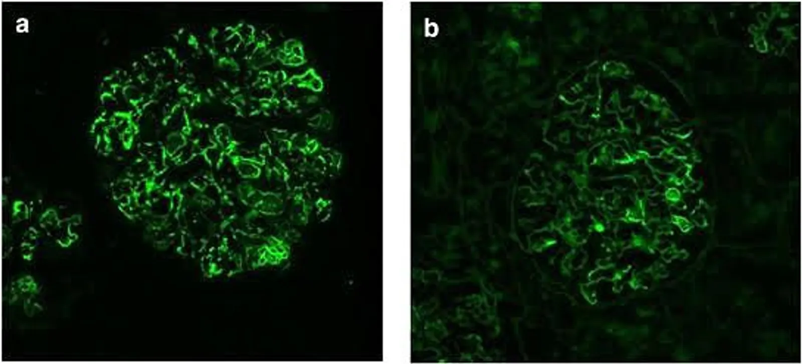 C3 Glomerulopathy- A new entity based on immunofluorescence